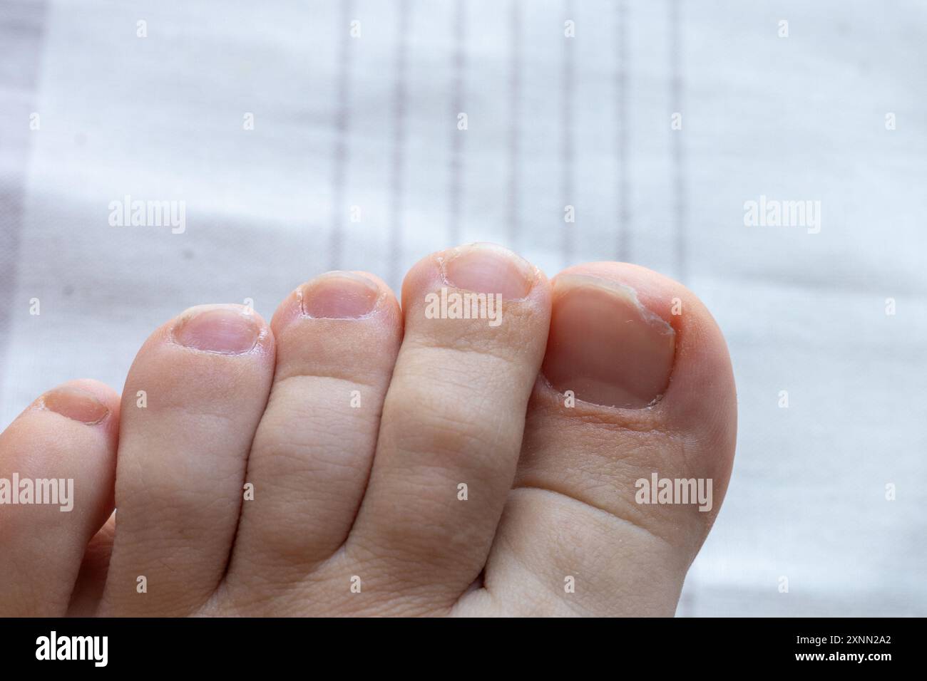 Nahaufnahme eines gebrochenen und verletzten Grosszehennagels Stockfoto