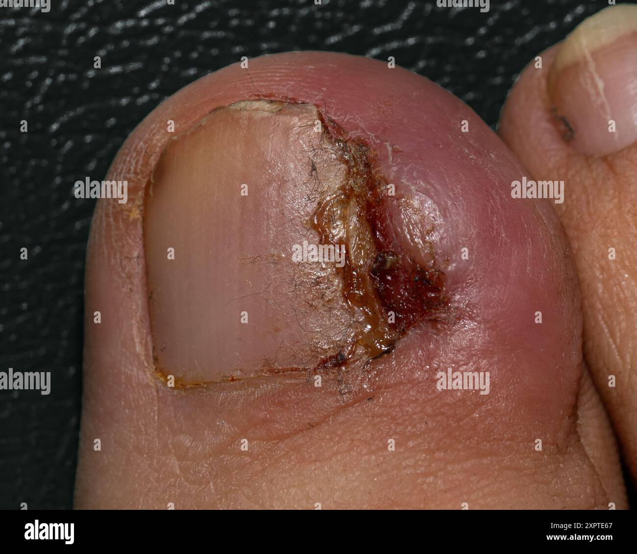 Detailbild eines Toes mit schwerer Infektion und ärztlicher Behandlung bedürftiger Wunde Stockfoto