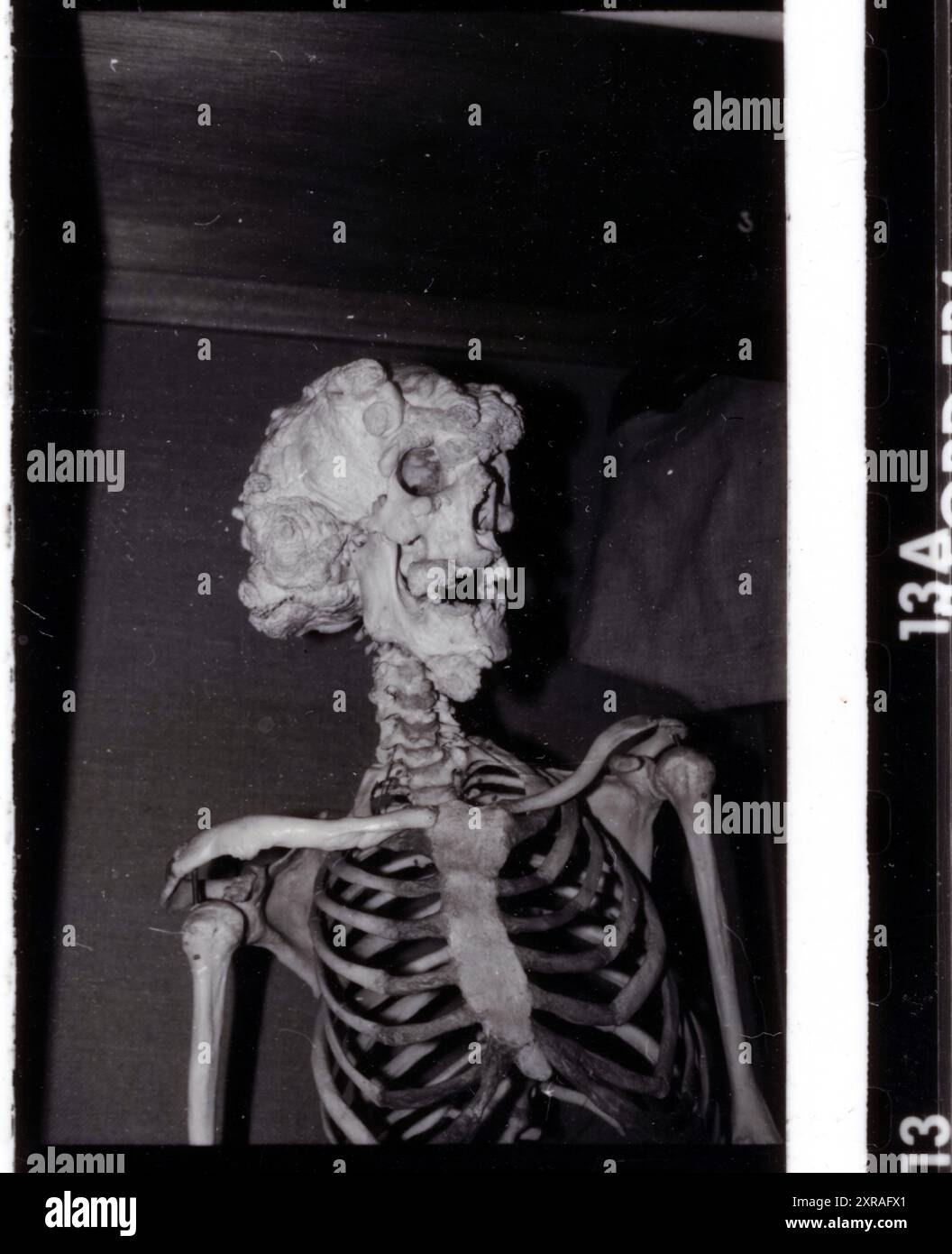 Joseph „John“ Carey Merrick (1862–90) – alias The Elephant man. Pathologische Sammlung des Royal London Hospital in Whitechapel um 1980 Stockfoto