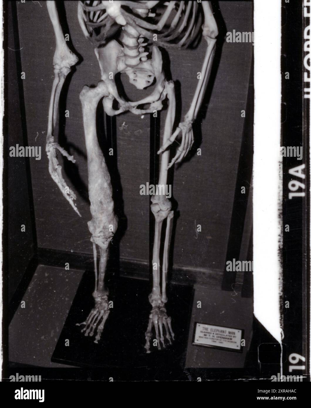 Joseph „John“ Carey Merrick (1862–90) – alias The Elephant man. Pathologische Sammlung des Royal London Hospital in Whitechapel um 1980 Stockfoto