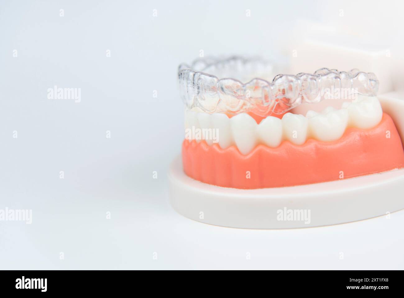 Zahnärztliche Versorgung. Aligner werden auf einem künstlichen Modell eines menschlichen Kiefers platziert. Stockfoto