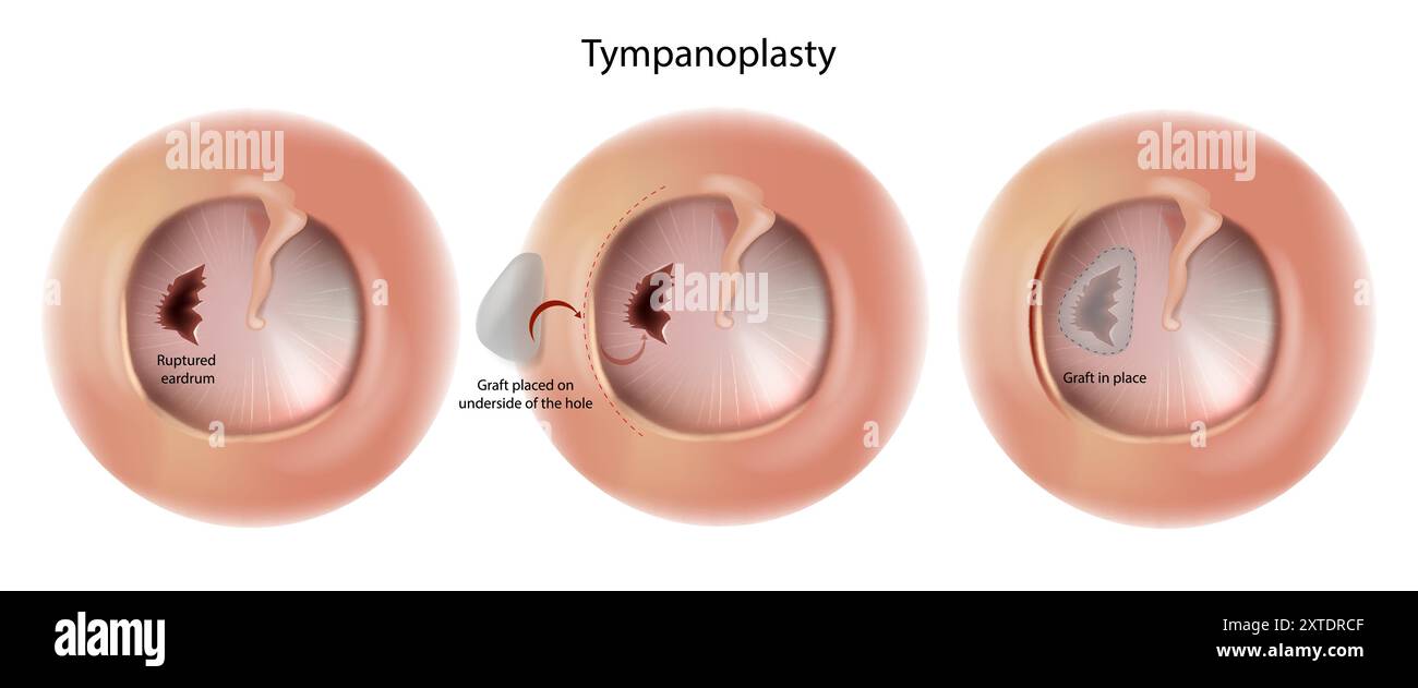 Trommelruptur. Tympanoplastik-Operation. Rekonstruktion des  Gehrmechanismus des Mittelohrs Stock-Vektorgrafik - Alamy