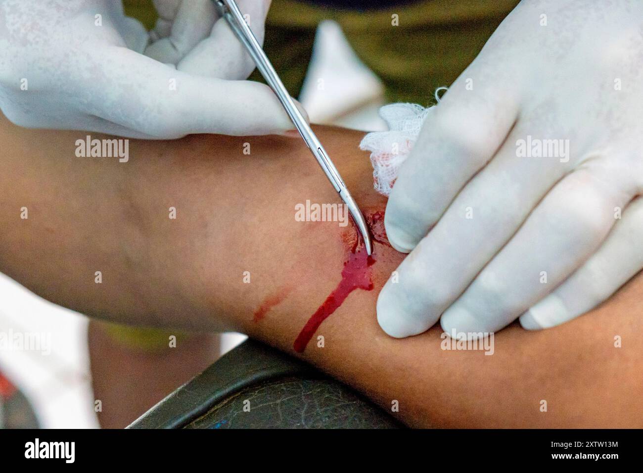 Entfernung von hormonellen Verhütungsmitteln, Lancetillo Gesundheitszentrum, La Parroquia, Quiche, Republik Guatemala, Zentralamerika Stockfoto