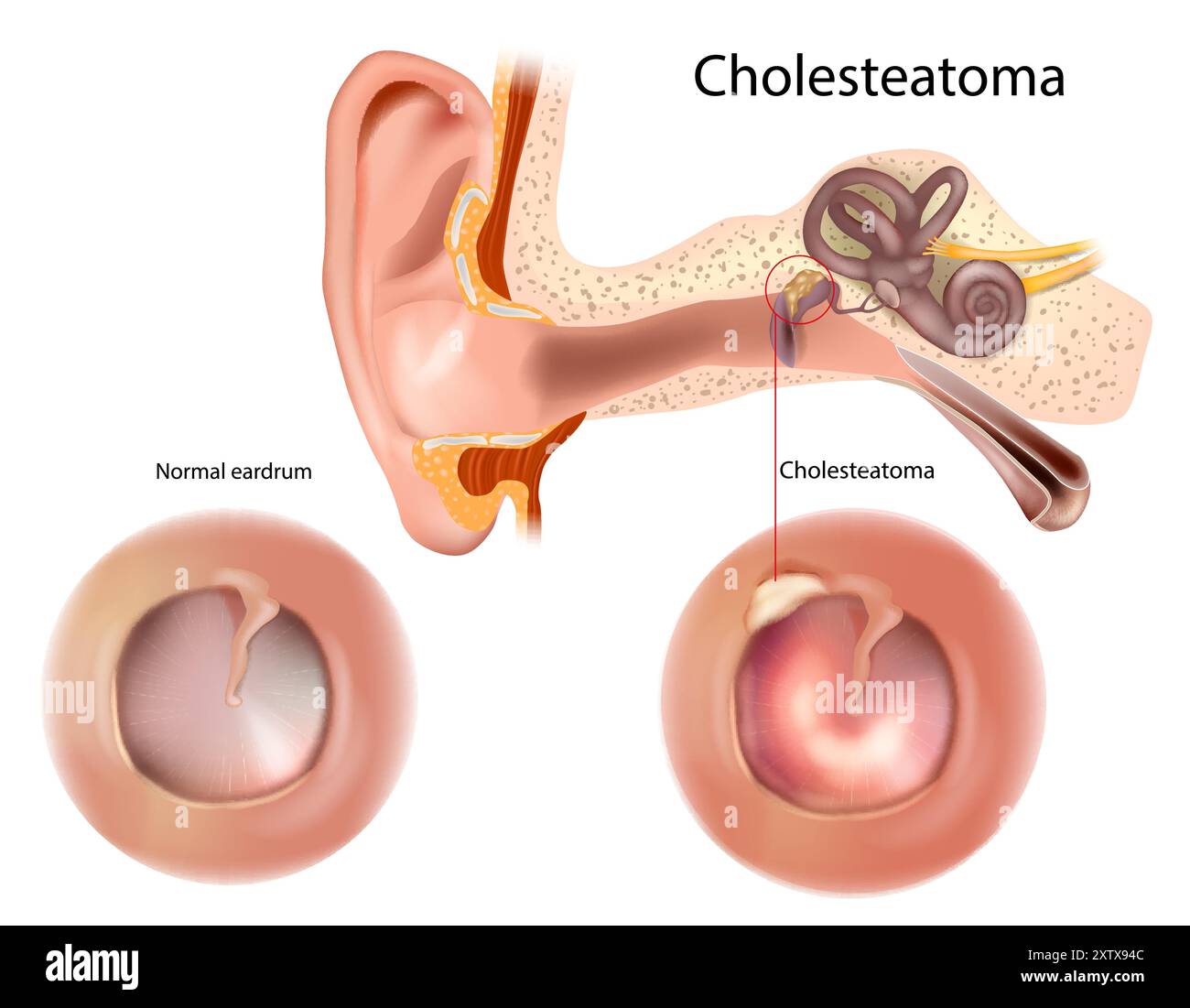 Cholesteatom und normales Trommelfell. Eingezogenes und perforiertes Trommelfell. Hals-Nasen-Ohrenheilkunde Stock Vektor