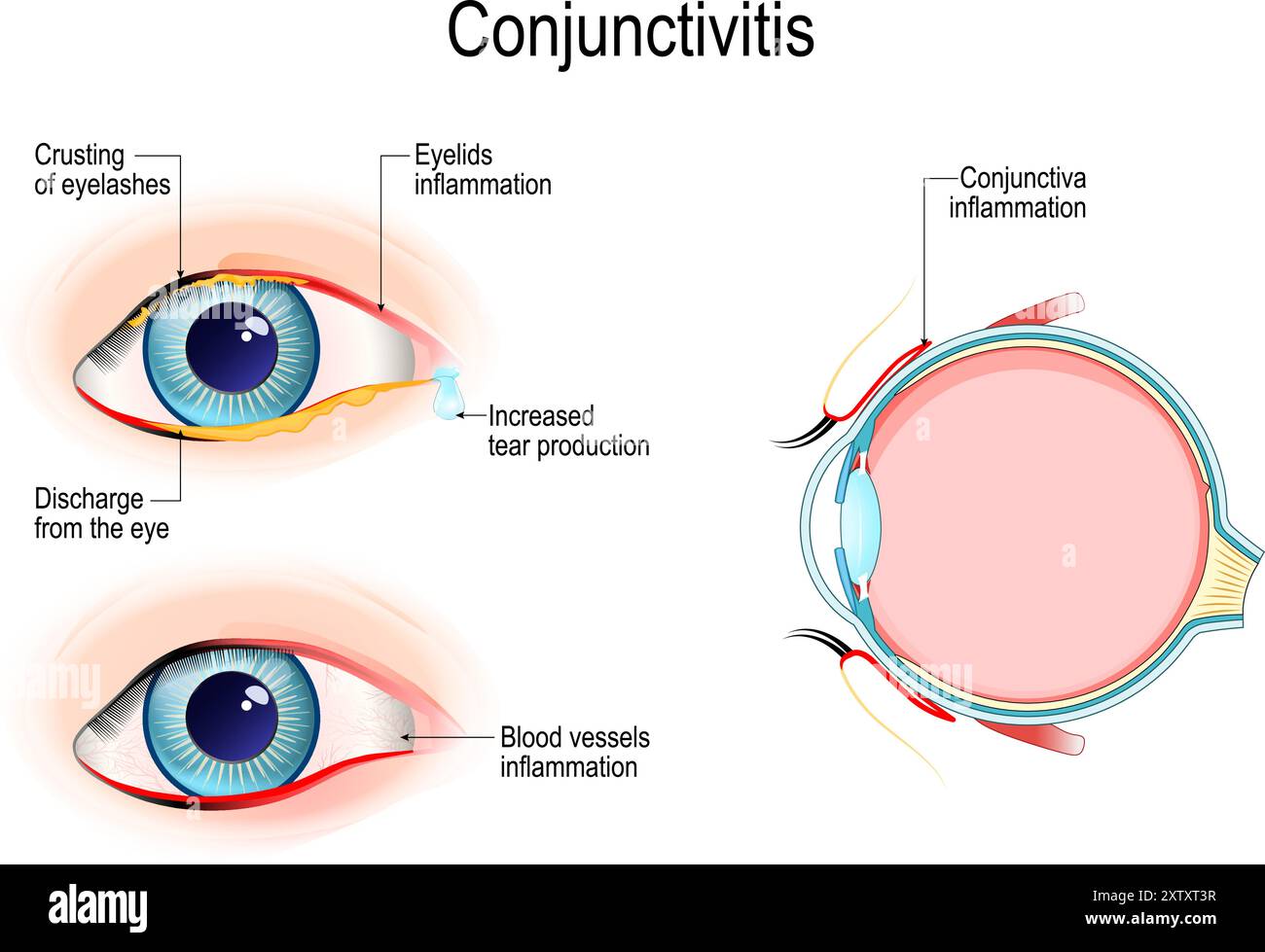 Konjunktivitis. Rosafarbenes Auge. Querschnitt eines menschlichen Augenlides mit Bindehautentzündung. Außenansicht Auge mit Verkrustung der Wimpern, Ausfluss aus Stock Vektor