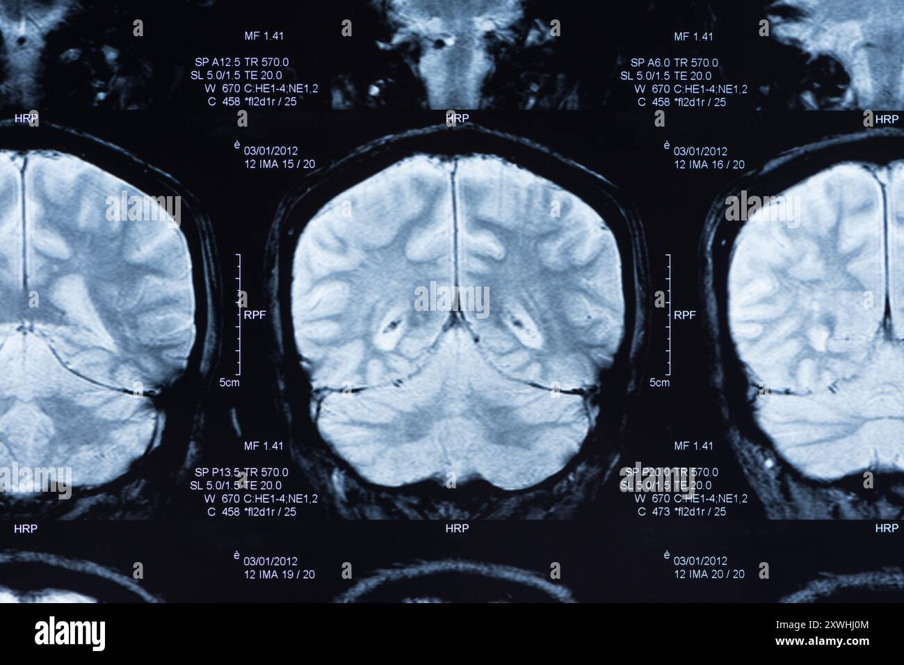 Bild eines Hirnscans durch ct-Scan. Stockfoto