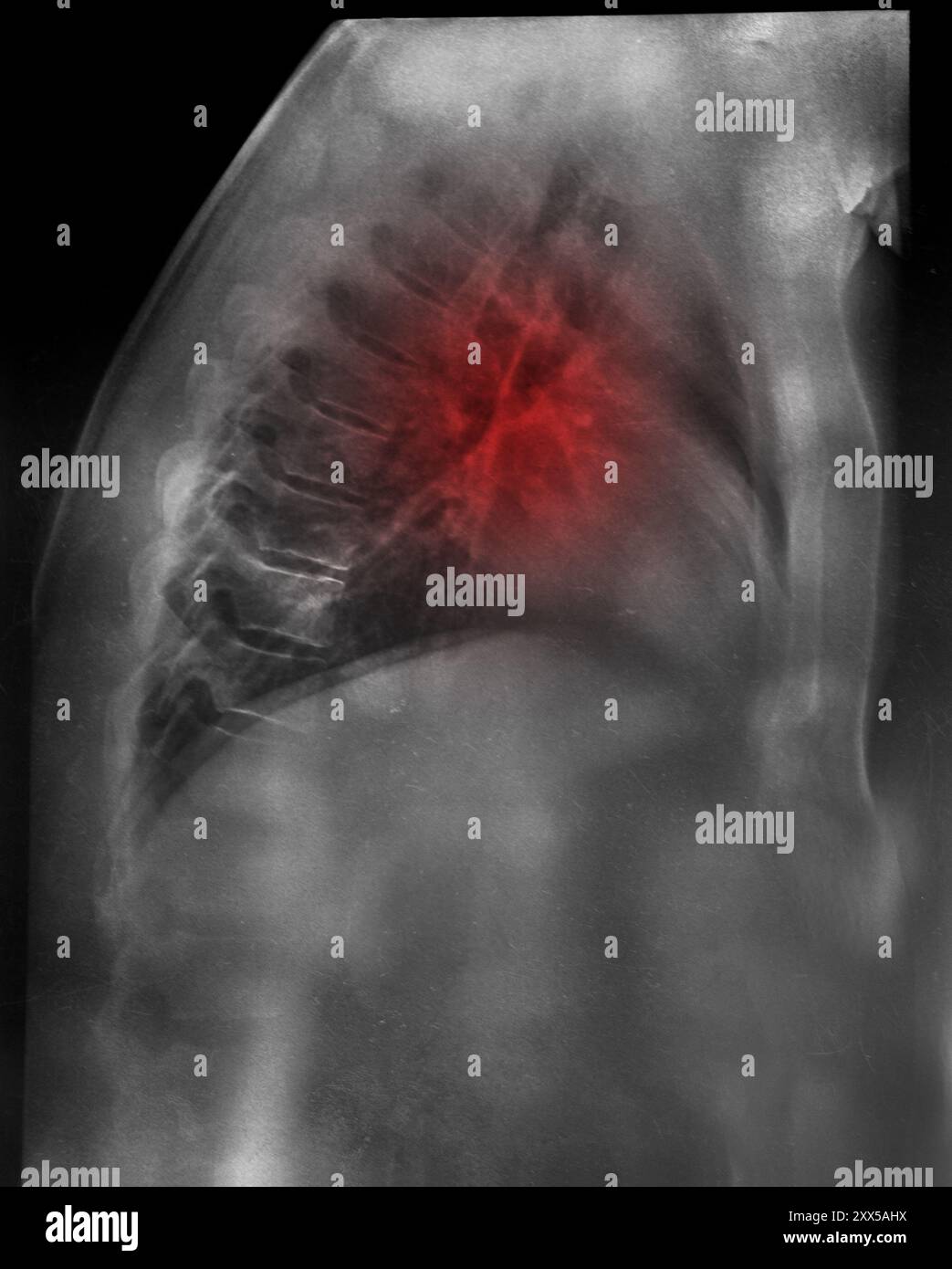 Thoraxröntgenaufnahme eines Mannes mit einem Herzinfarkt und hervorgehoben mit einem roten Fleck, Herzinfarkt und Diagnose Stockfoto