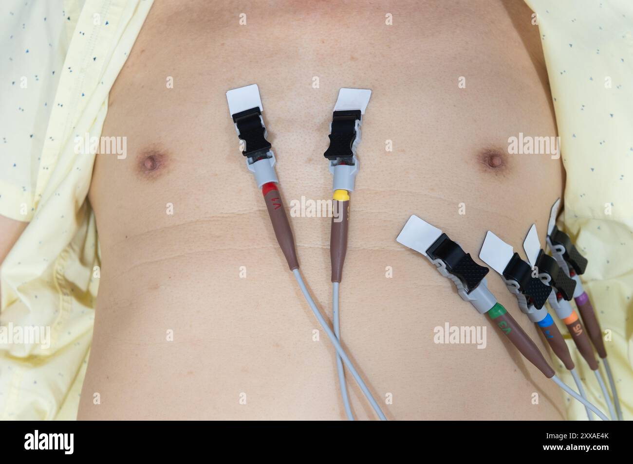 Nahaufnahme eines Mannes-Thorax mit Elektroden zur elektrokardiographischen Messung Stockfoto