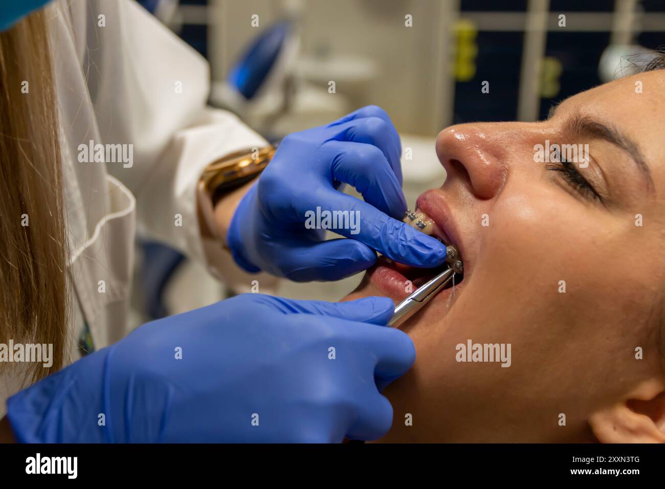 Montageprozess provisorischer Zahn in selbstligierenden Zahnspangen für ein perfektes Lächeln. Kieferorthopädische Zahnbehandlung. Zahnärztliche Versorgung. Stockfoto