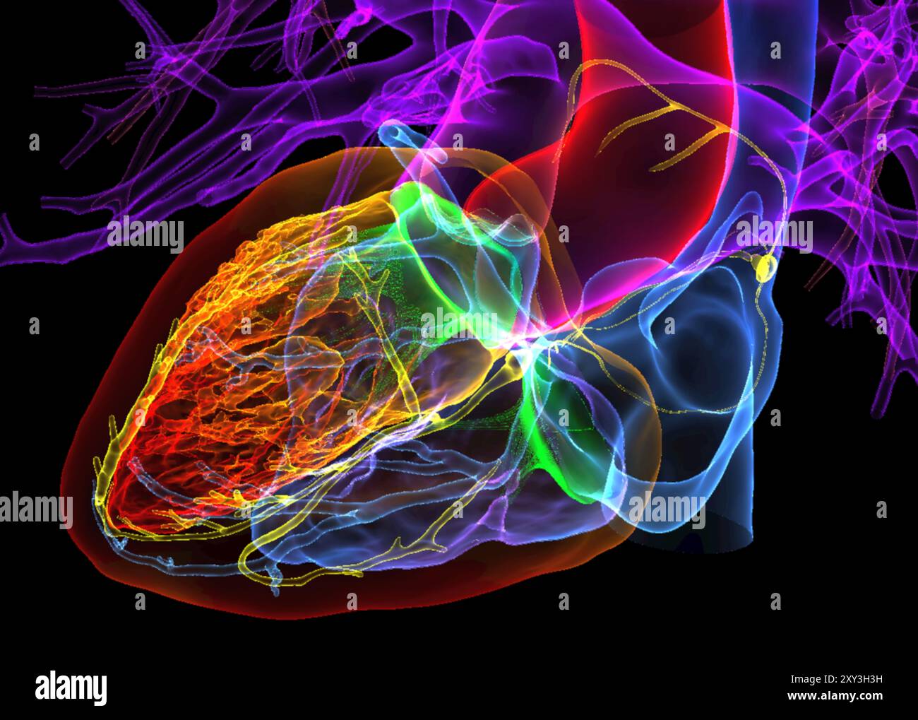 Farbige Computertomographie (CT) des menschlichen Herzens, die das kardiale Überleitungssystem (gelb) hervorhebt. Stockfoto