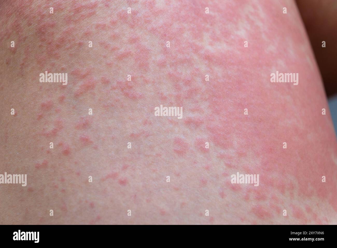 Rash allergy -Fotos und -Bildmaterial in hoher Auflsung  Alamy
