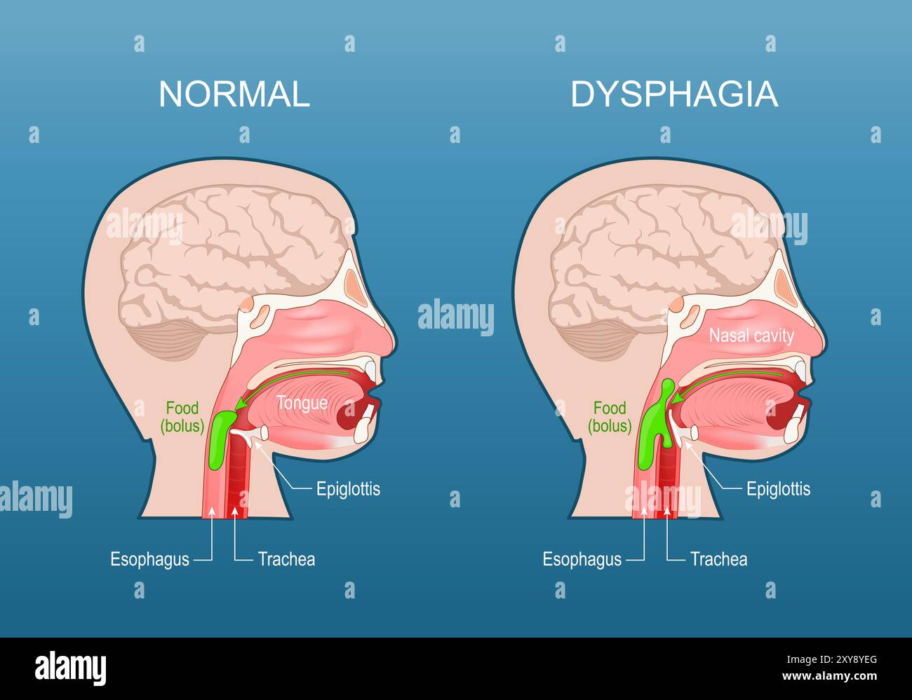 Dysphagie. Schluckbeschwerden. Osophagusdysphagie. Aspirationsrisiko. Querschnitt eines menschlichen Kopfes mit Ösophagus, Luftröhre, Nasenhöhle, Zunge Stock Vektor