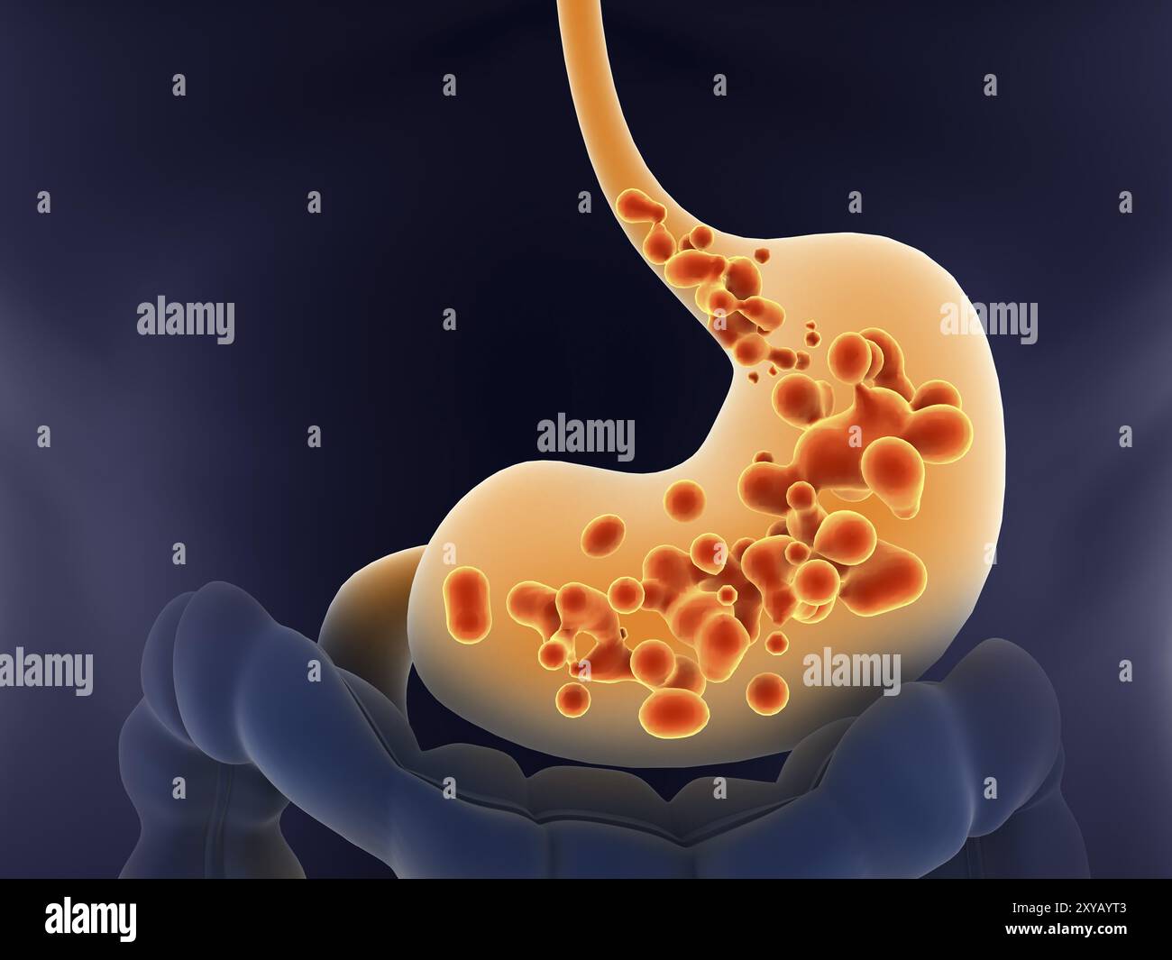 Medizinische Illustration des sauren Refluxes im menschlichen Magen Stockfoto