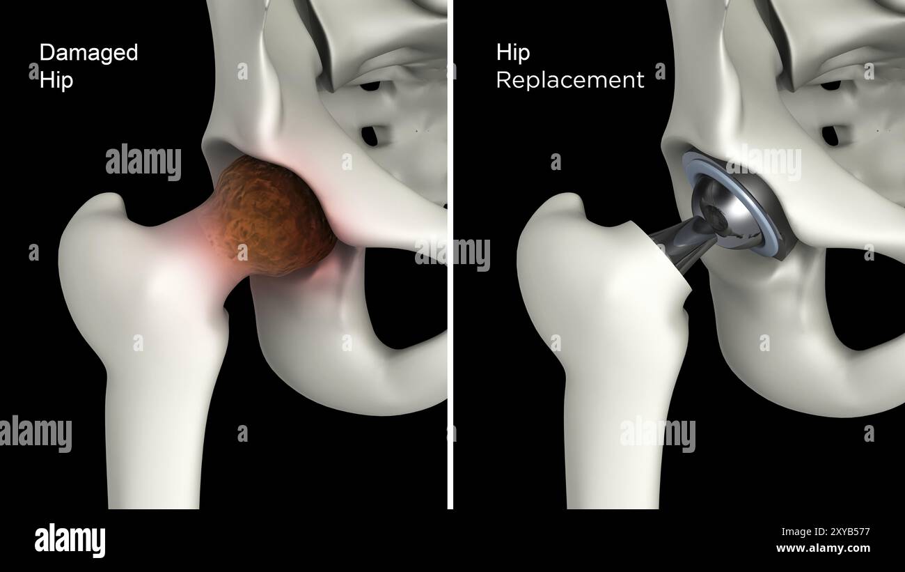 Medizinische Illustration des Hüftgelenksersatzes bei geschädigter Hüfte Stockfoto