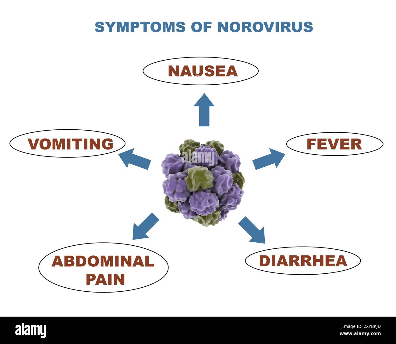 Medizinische Darstellung der Symptome des Norovirus Stockfoto