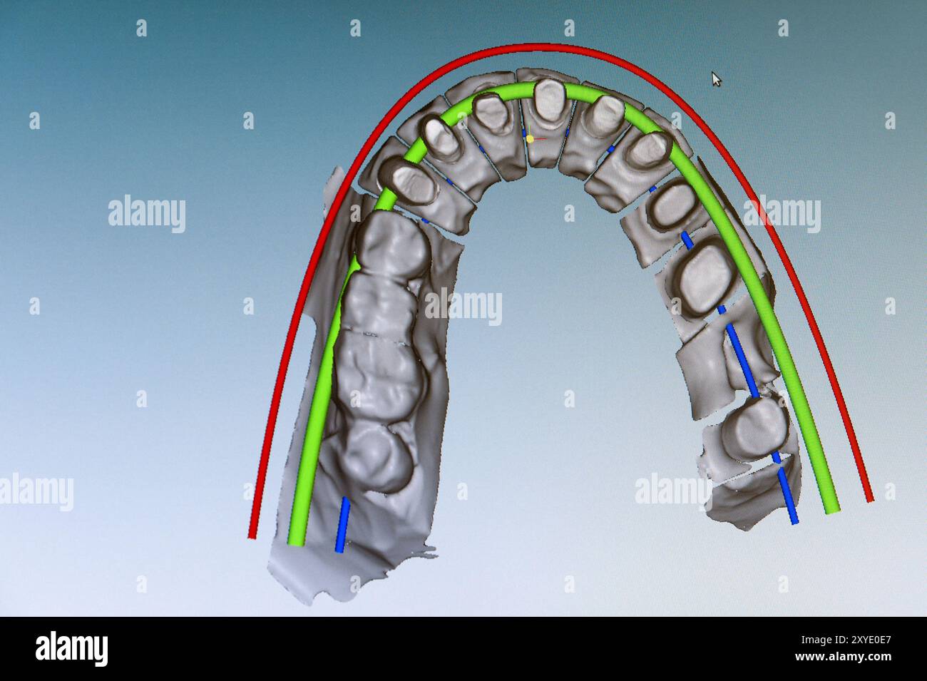 Anzeige des Modells der Oberkiefer auf dem Monitor Stockfoto