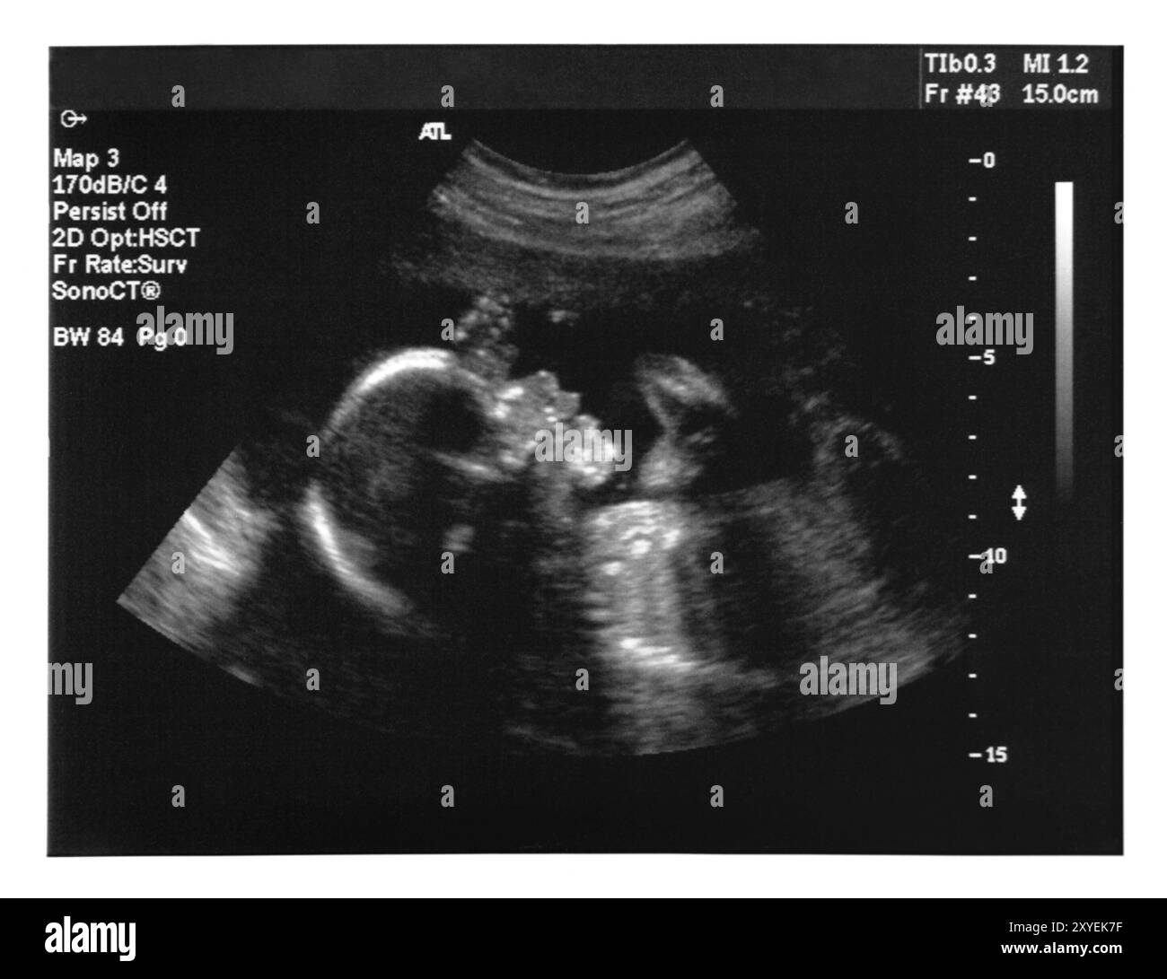 Ultraschallbildgebung eines Babys. Fünf Monate alter Fetus Stockfoto