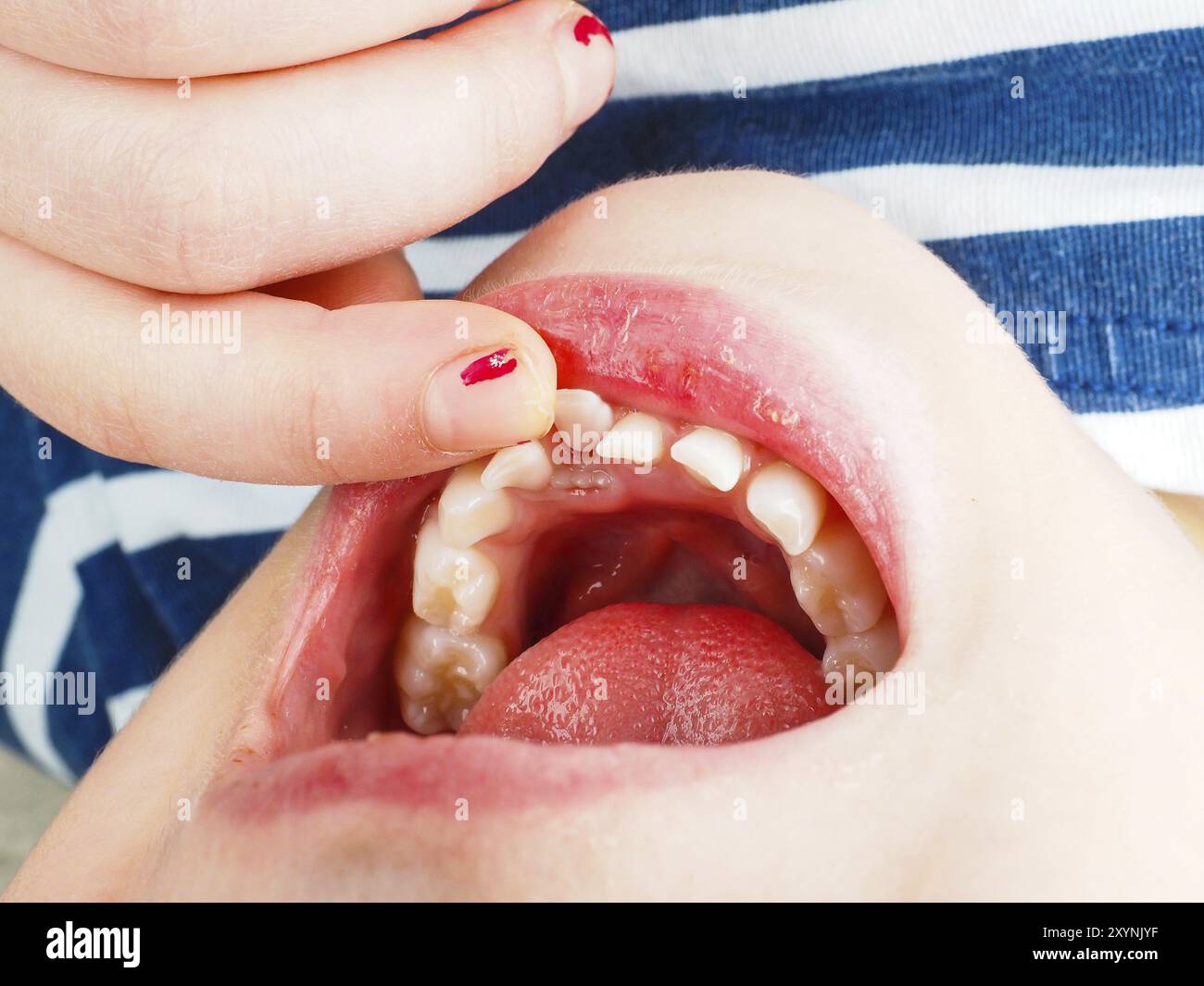 Nahaufnahme eines Fingers, der einen verlorenen Zahn im Mund eines kleinen Mädchens spürt Stockfoto