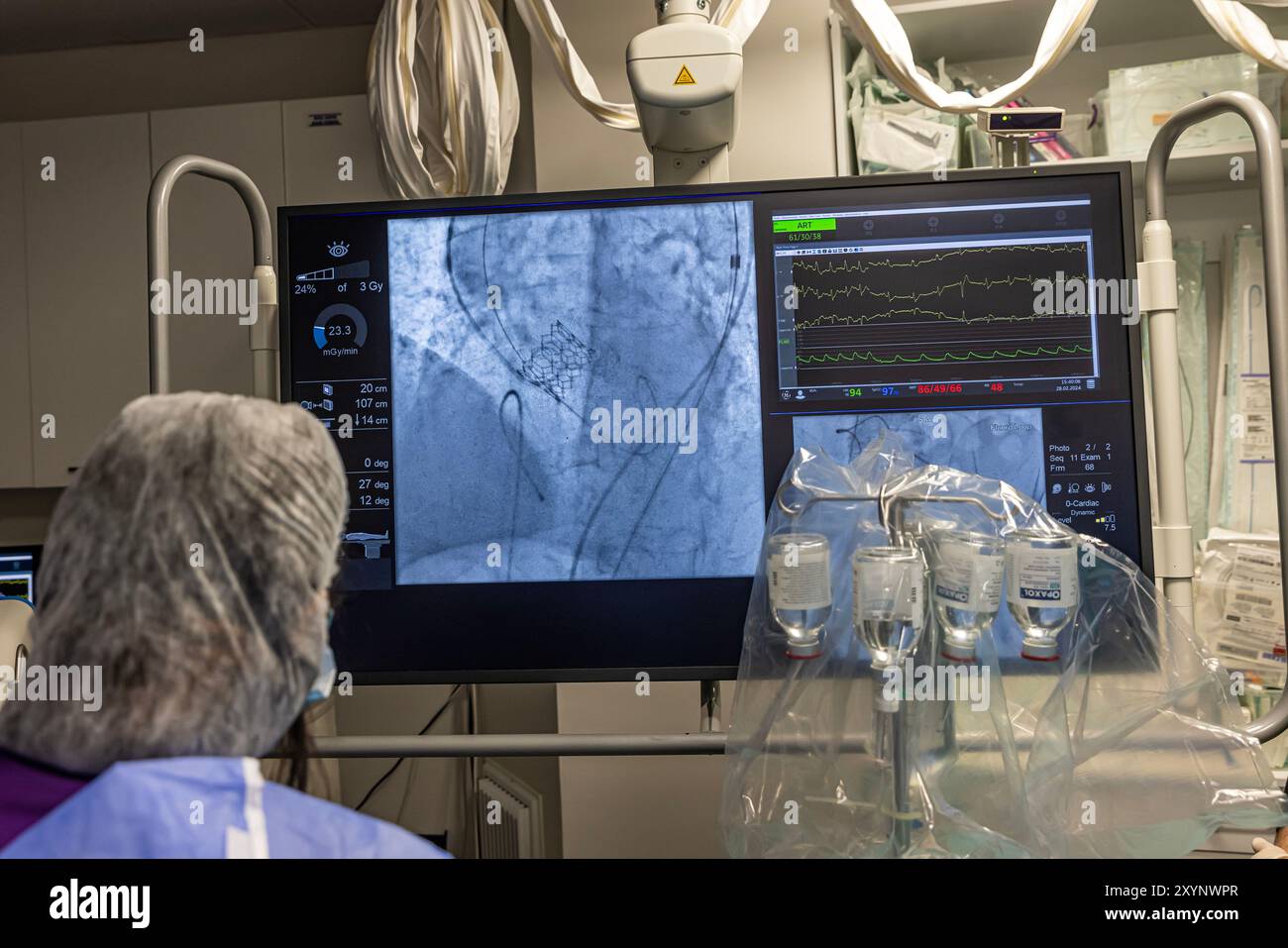 Istanbul, Türkei 29. Februar 2024; Röntgen für Klappenersatz mit Melodiebahn. Sicht auf prothetische Herzklappendysfunktion bei Patienten mit MI Stockfoto