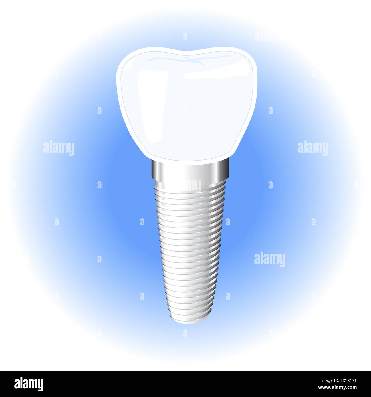 Dentale Implantatvektorillustration isoliert auf weißblauem Hintergrund Stockfoto