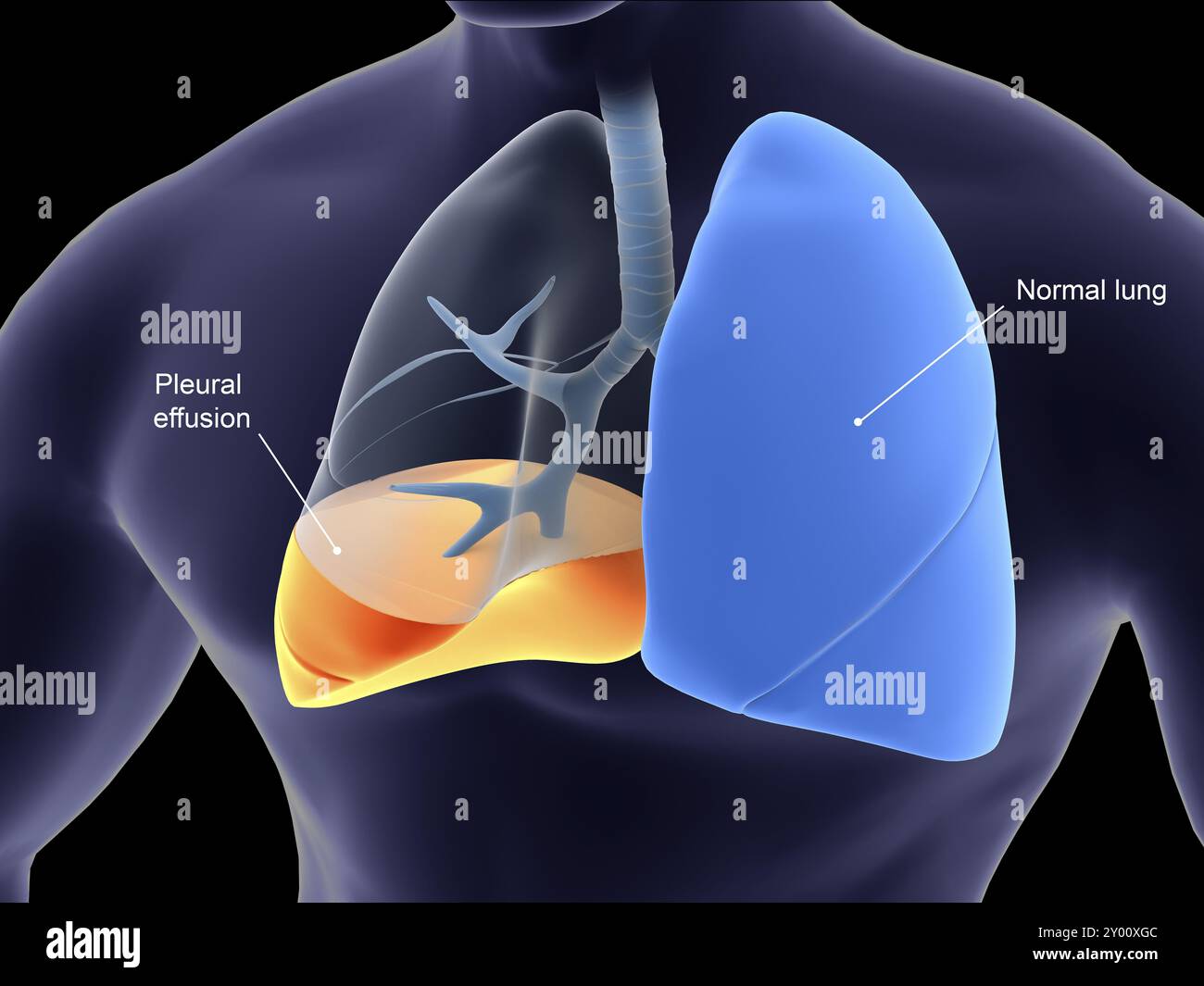 Medizinische Illustration der Pleuritis. Pleuritis ist eine Entzündung der Membranen, die die menschliche Lunge umgeben Stockfoto