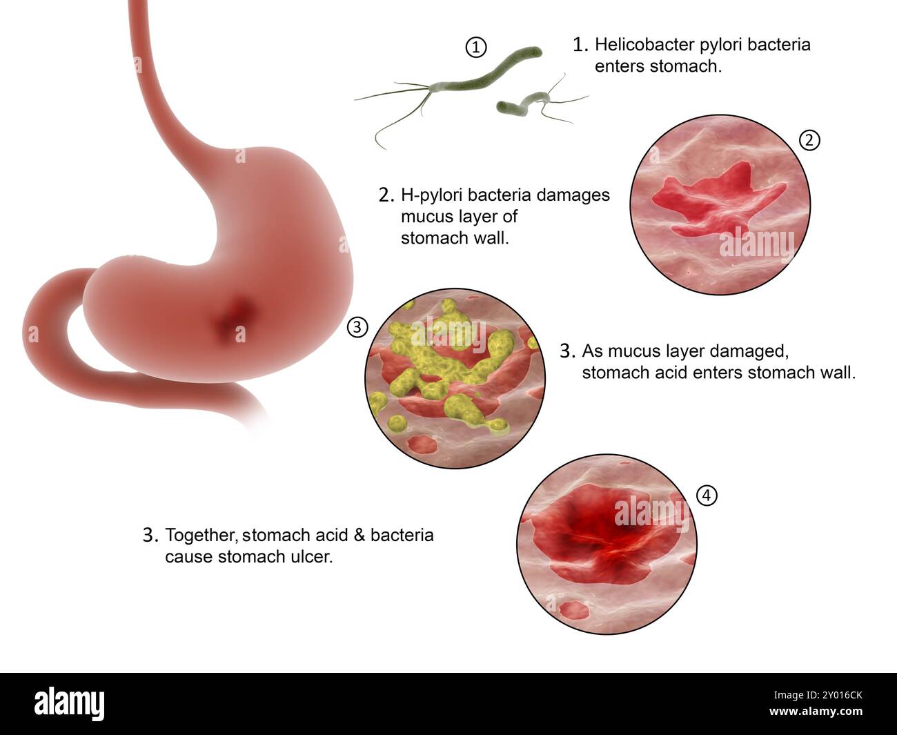 Medizinisches Diagramm, das den Prozess von Helicobacter pylori Bakterien zeigt, die in den Magen gelangen und Geschwüre verursachen Stockfoto