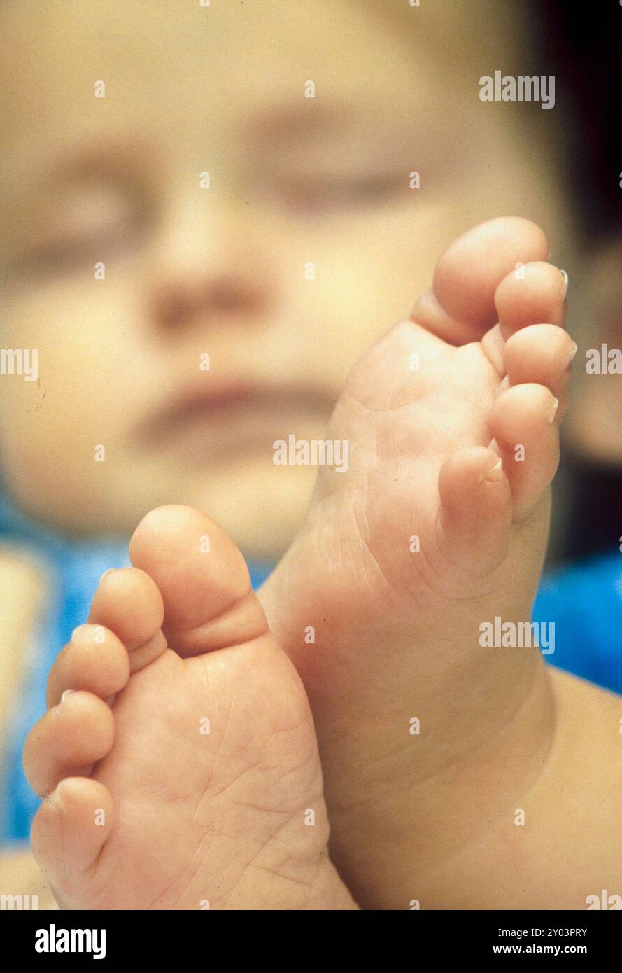 Nahaufnahme eines 6 Monate alten Jungen, der mit den Füßen des Jungen im Vordergrund schläft. ©1994 Stockfoto