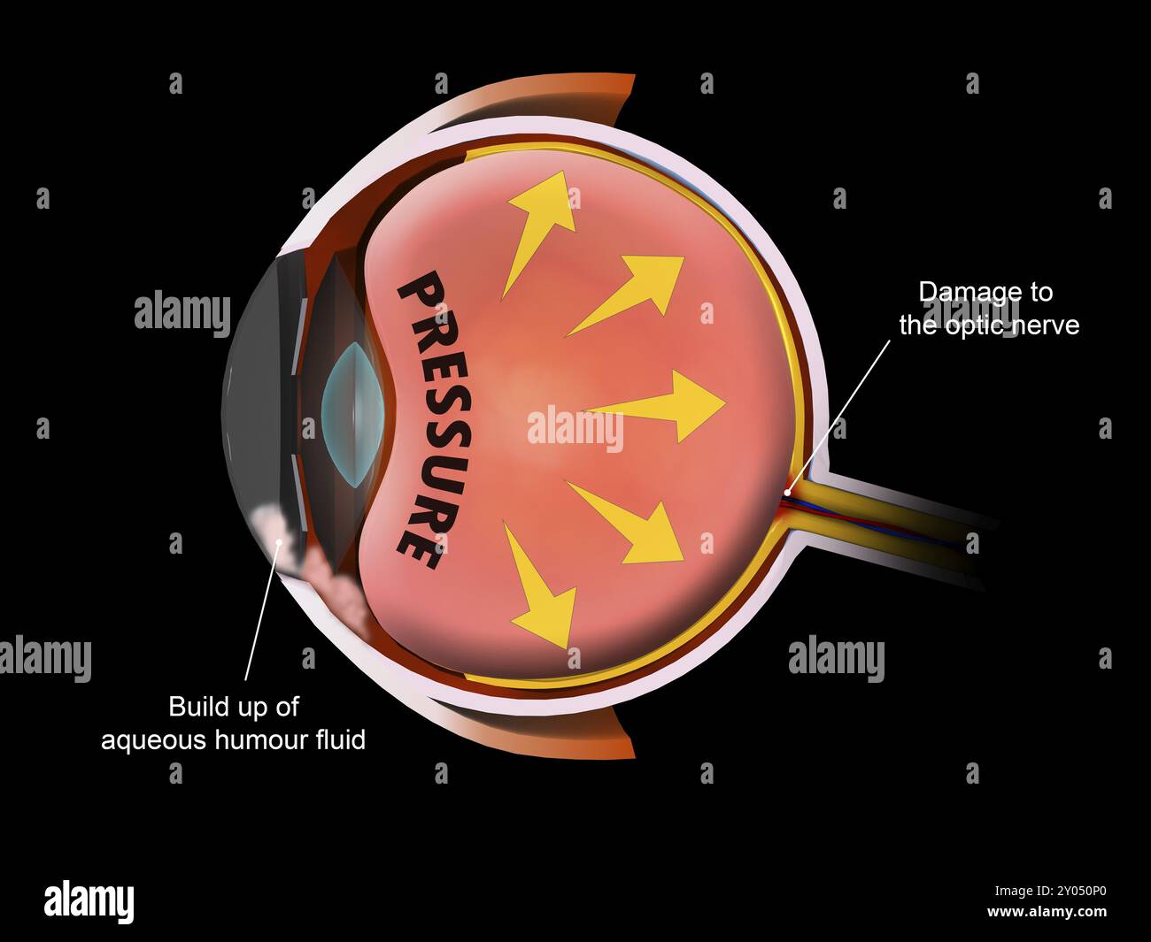 Medizinische Illustration zeigt erhöhten Druck im Augapfel, was zu Glaukom führt Stockfoto