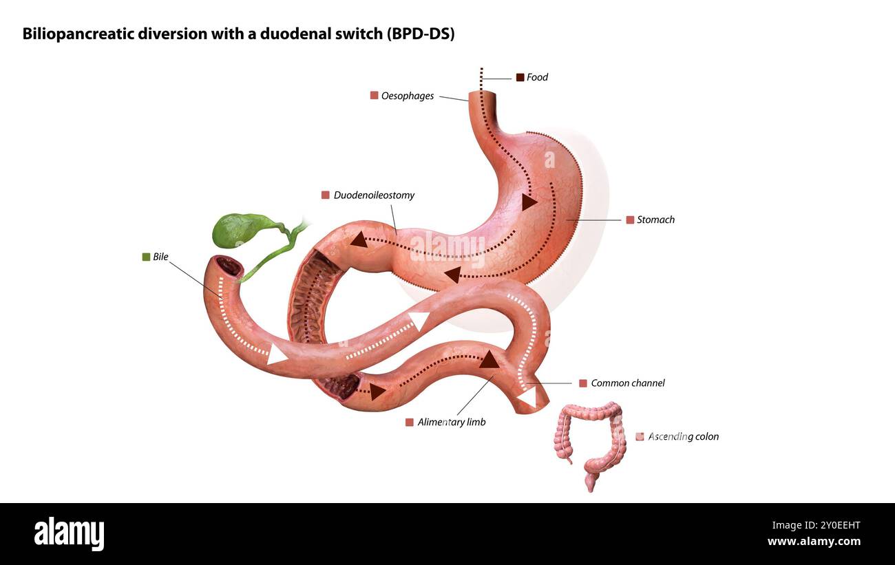 Magen, Nahrungsweg, Duodenoileostomie, Gallenfluss, alimentäre Extremität, gemeinsamer Kanal und aufsteigender Doppelpunkt, 3D-Grafik Stockfoto