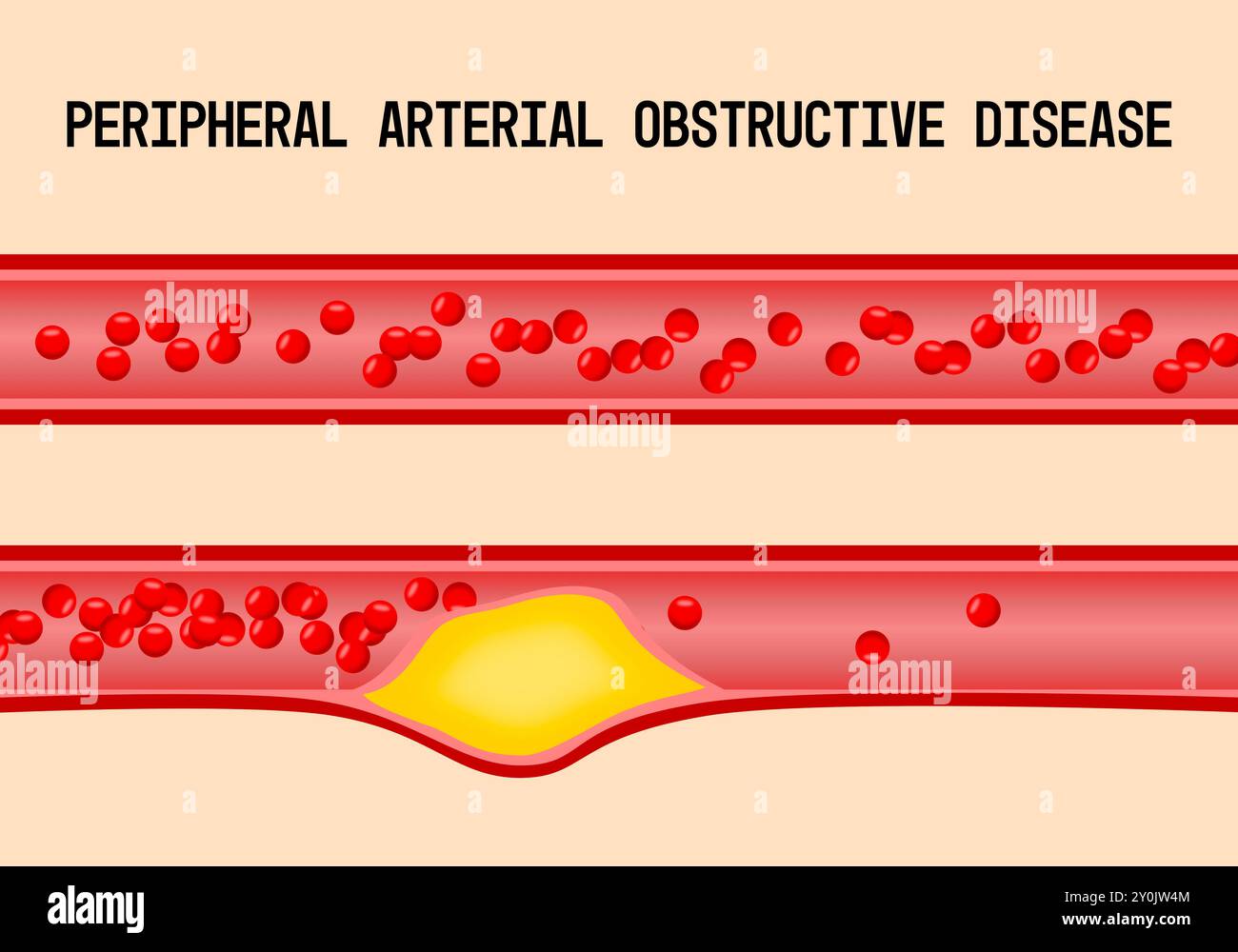 Was Ist Periphere Arterielle Verschlusskrankheit www.alamy.de