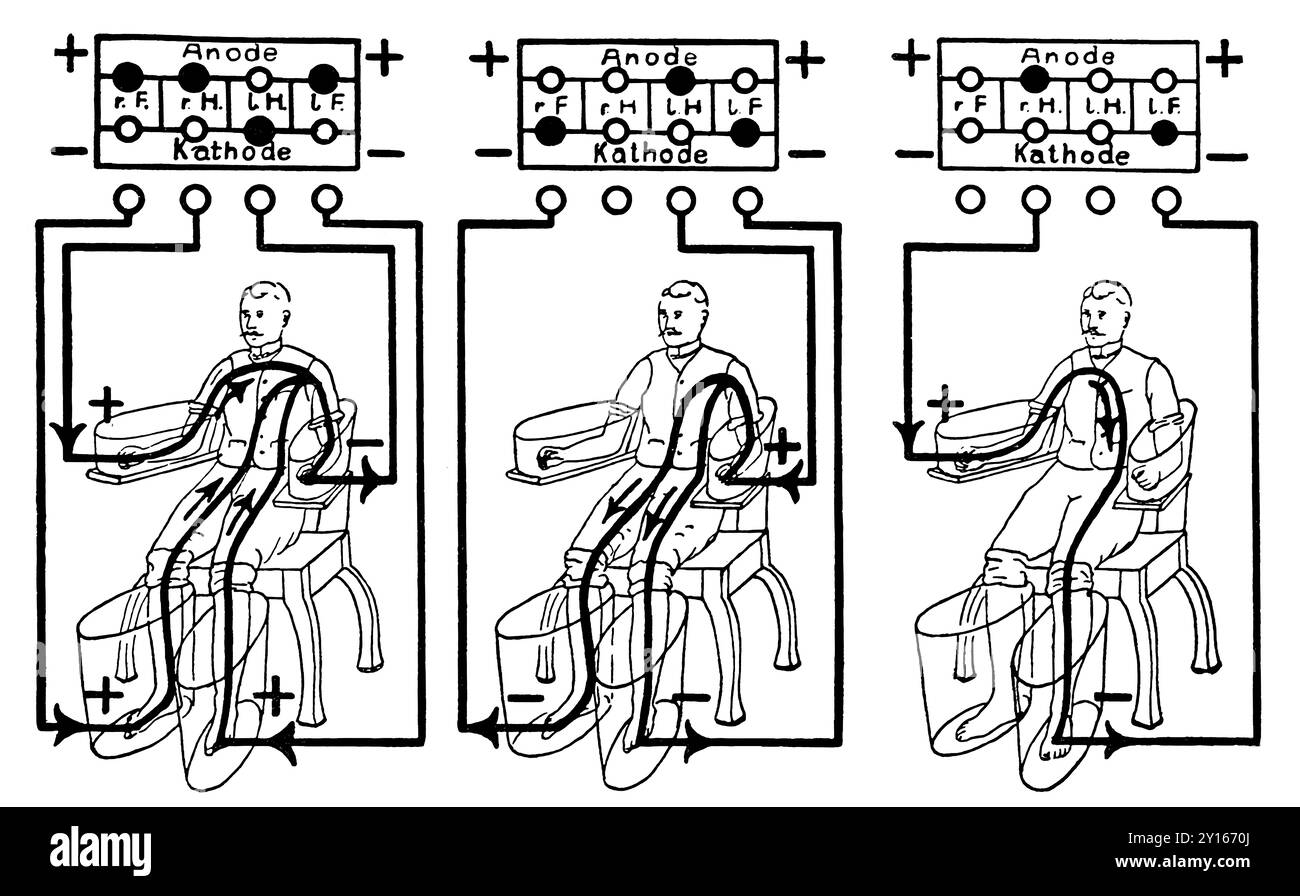 Eine Illustration eines Patienten, der mit einem vierzelligen Schneebad behandelt wird, einem frühen elektrischen medizinischen Gerät zur Behandlung von Rheuma Stockfoto