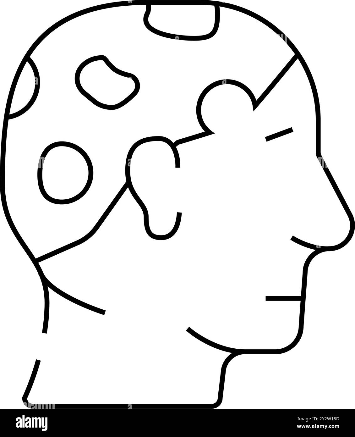 Alopecia areata Linie Symbol Vektor Illustration Stock Vektor