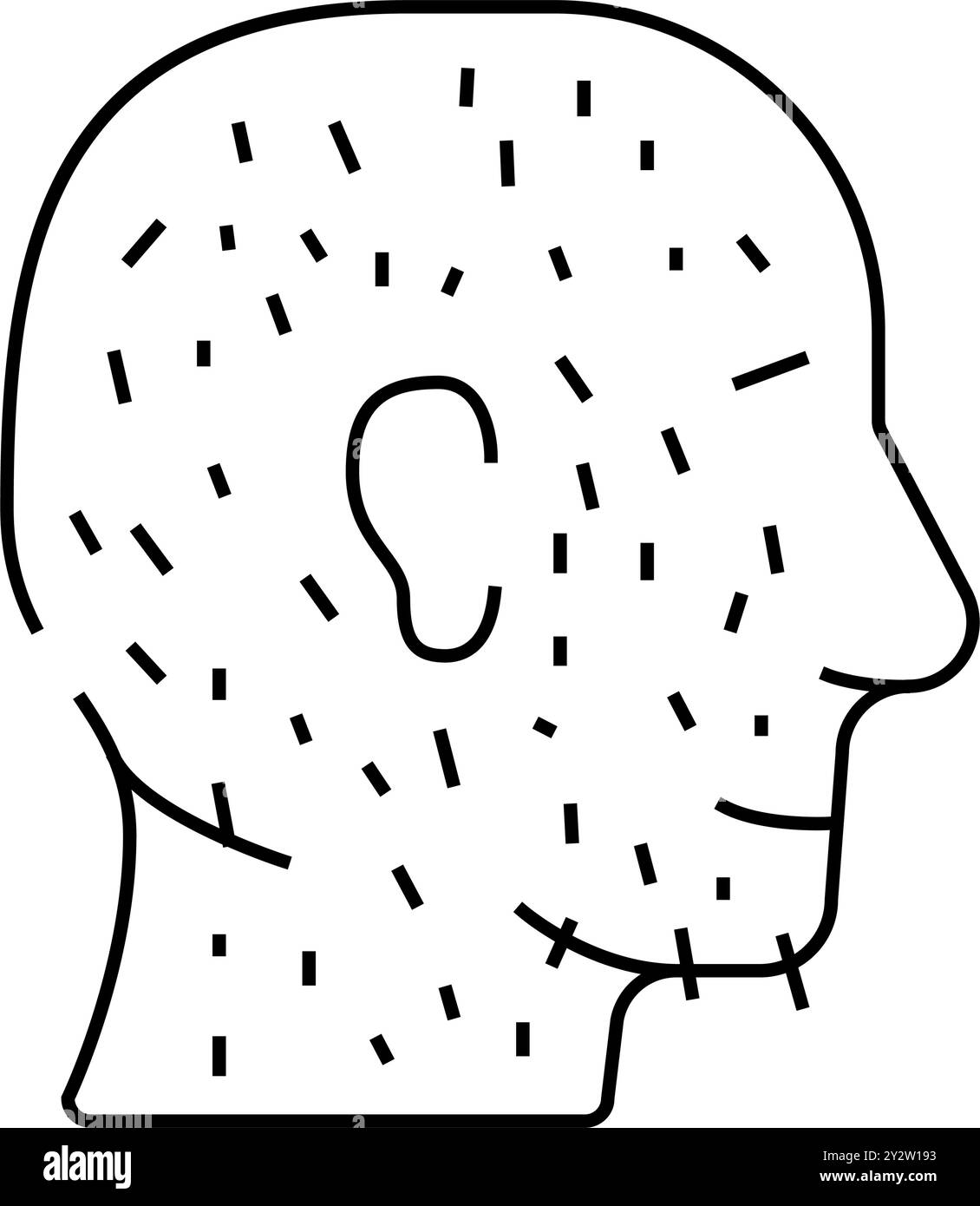 Hypertrichose Hautkrankheit Linie Symbol Vektor Illustration Stock Vektor