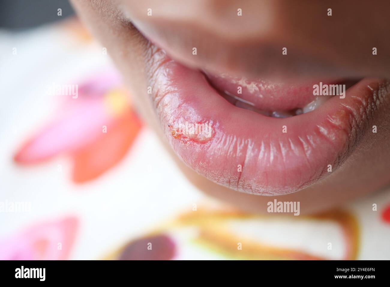 Nahaufnahme der trockenen Lippe eines Kindes Stockfoto