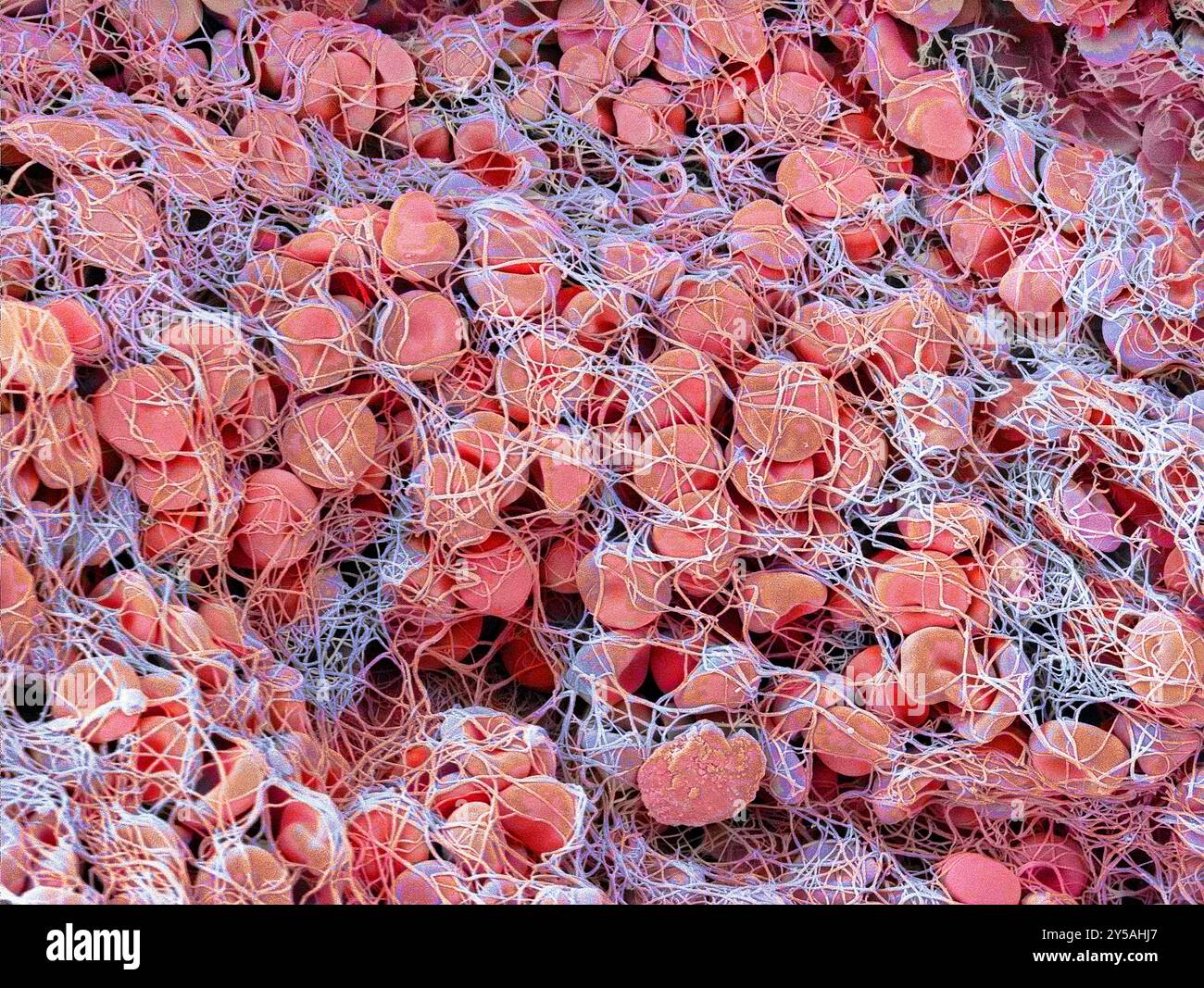 Blutgerinnsel. Farbige Rasterelektronenmikrographie (REM) von roten Blutkörperchen (Erythrozyten), die in einem Fibrinnetz eingeschlossen sind. Die Fibrinproduktion wird von Zellen, die als Thrombozyten bezeichnet werden, ausgelöst, wenn ein Blutgefäß beschädigt wird. Das Fibrin bindet die verschiedenen Blutzellen zusammen und bildet eine feste Struktur, die als Blutgerinnsel bezeichnet wird. Ein Blutgerinnsel ist eine normale Reaktion, die einen übermäßigen Blutverlust verhindert. Inadäquate Gerinnung ist jedoch eine der Hauptursachen für Herzinfarkte und Schlaganfälle. Vergrößerung x 2000 bei 10 cm Breite. Stockfoto