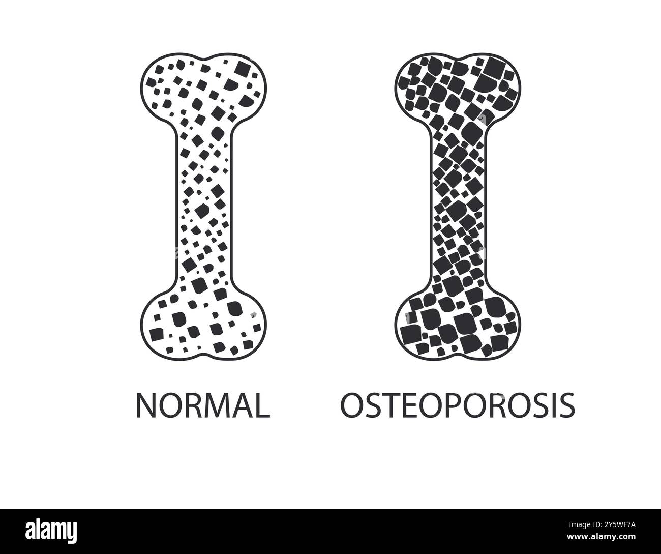 Osteoporose, Knochen, Krankheitssymbol. Vektorabbildung. Stock Vektor