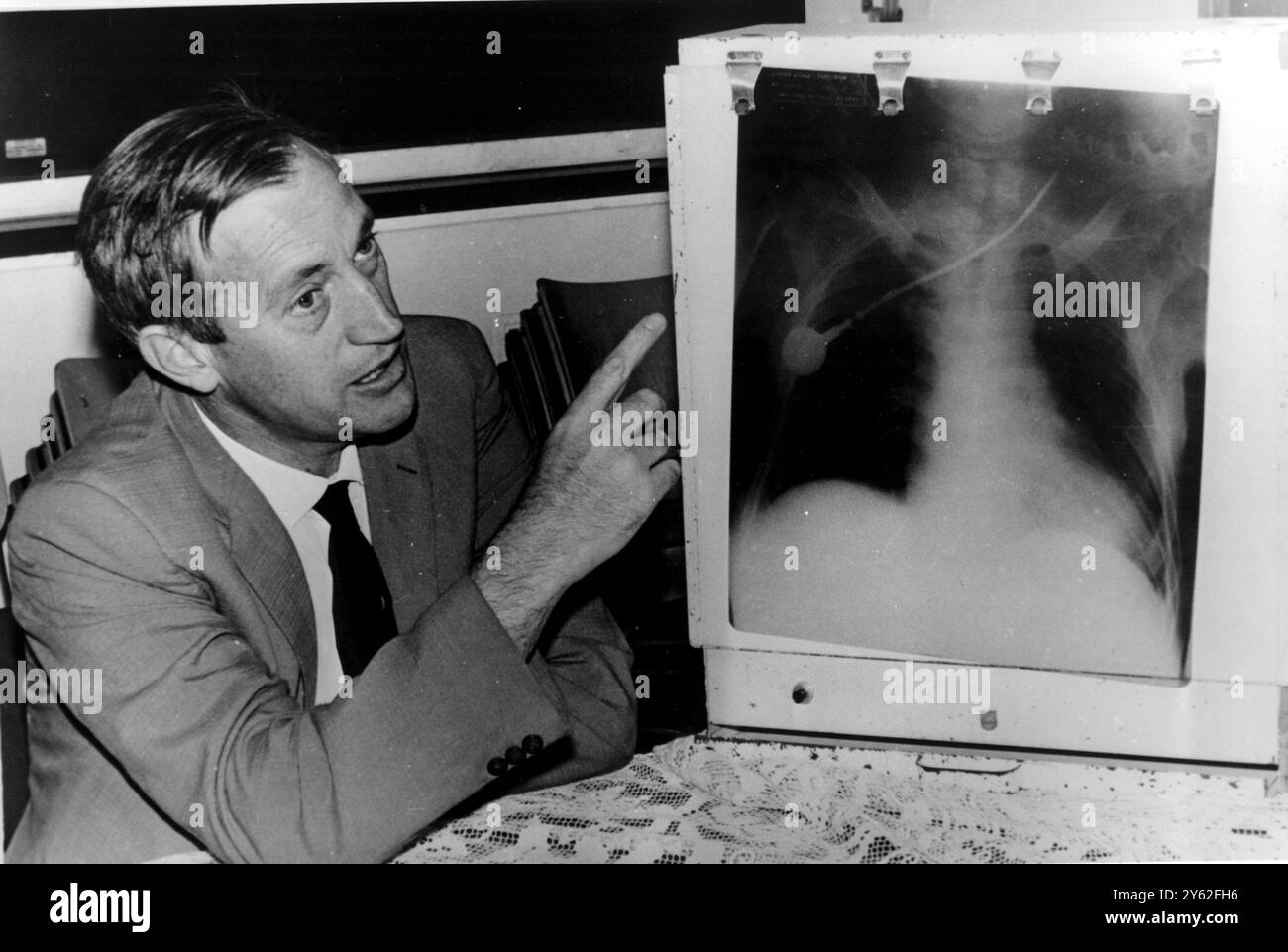 Professor Christian Barnard zeigt auf ein Röntgenbild von Washkanskys Brust, während er die Operation erklärt Stockfoto