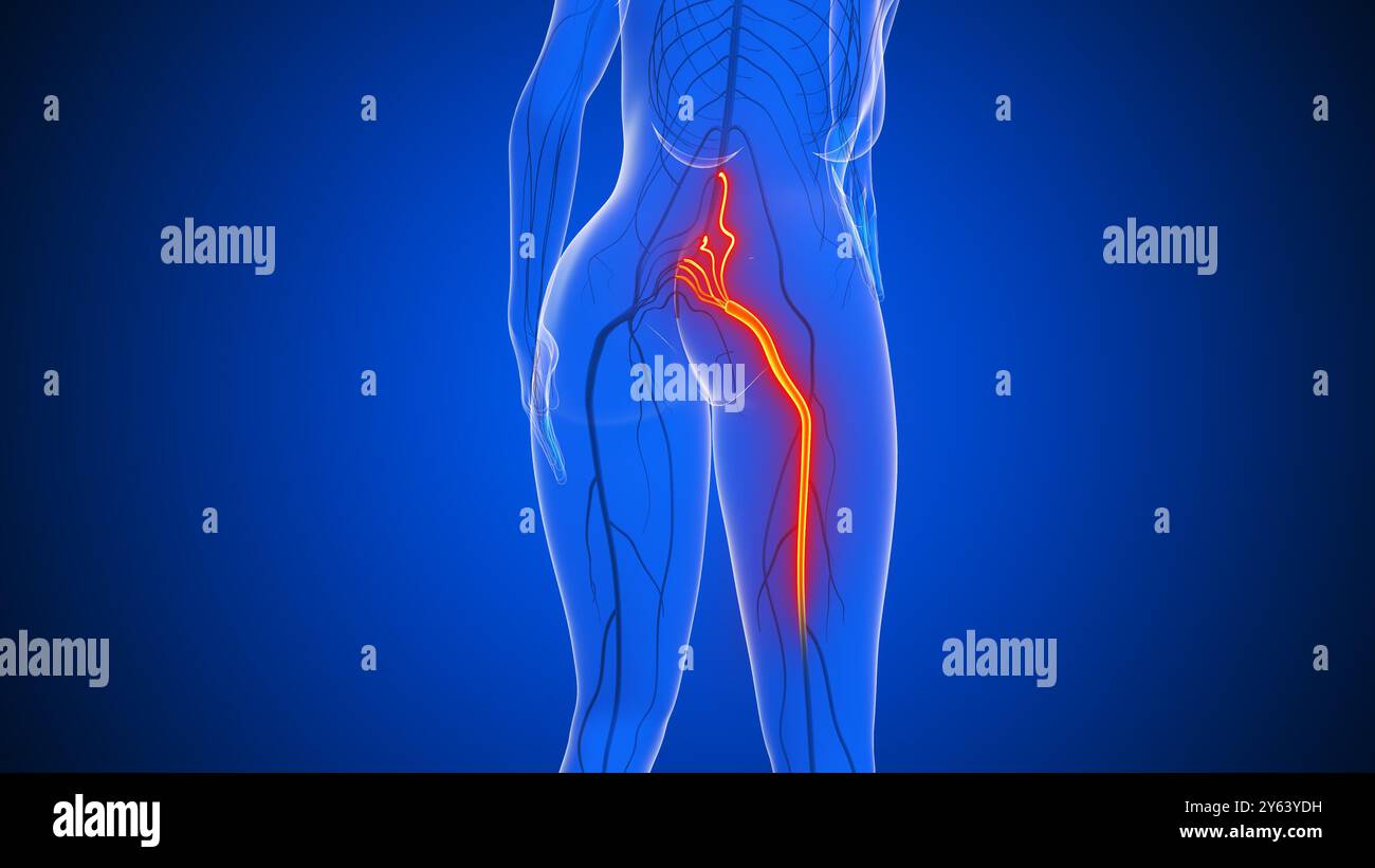 Nervenschmerzen des Ischias im menschlichen Körper Stockfoto