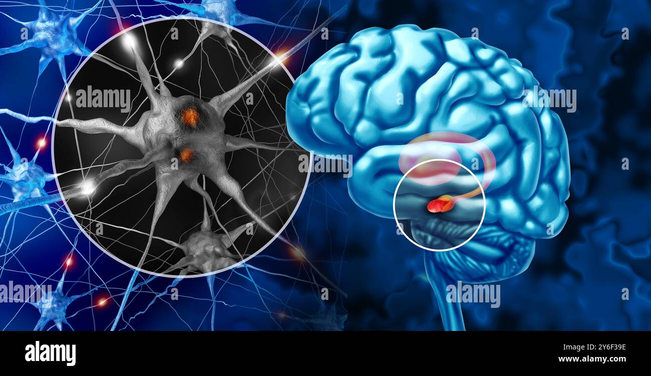 Substantia Nigra und Morbus Parkinson als progressive neurologische Störung, die die Körperbewegung und Koordination als Nervenzellen beeinflusst, die ihre Funktion verlieren Stockfoto