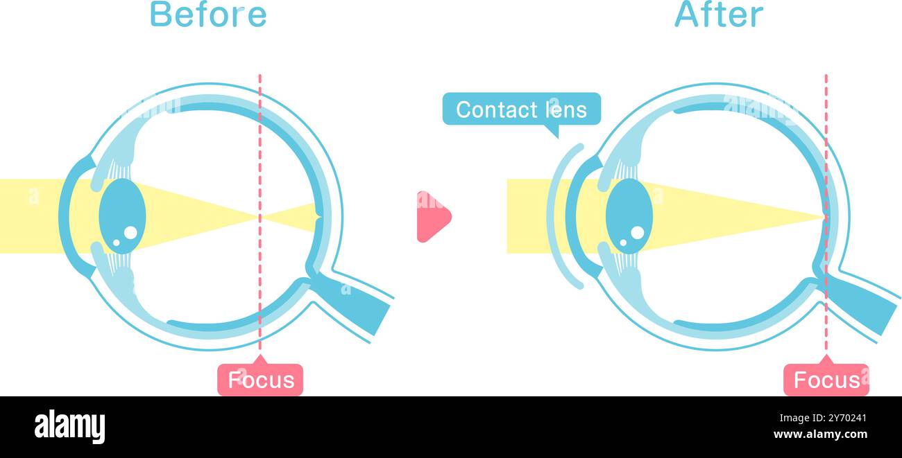Abbildung zum Vergleich des Sehvermögens vor und nach dem Tragen einer Kontaktlinse Stock Vektor