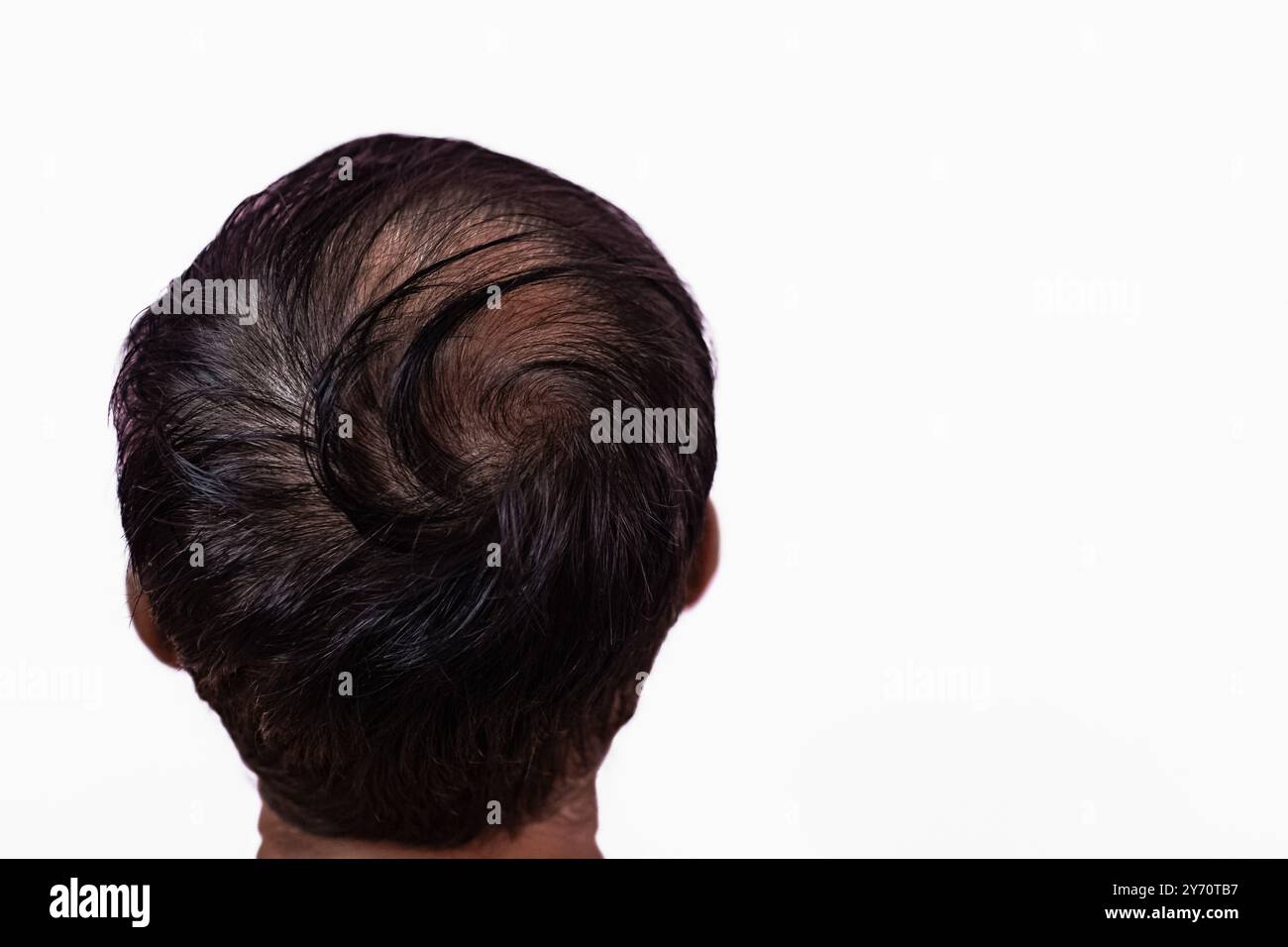 Rückansicht eines männlichen Kopfes mit Haarausfall auf weißem Hintergrund. Haarausfall-Problem eines Mannhaares, Nahaufnahme. Kahlheit, Alopezie. Mann verliert Haare, Kahlheit Stockfoto