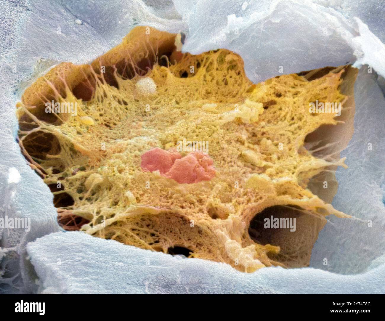 Osteozyten-Knochenzelle. Farbige Rasterelektronenmikrographie (REM) einer von Knochengewebe umgebenen Osteozytenknochenzelle. Diese gebrochene Zelle zeigt einen Kern in der Mitte. Osteozyten sind Osteoblasten (knochenbildende Zellen), die in Knochenhöhlen eingeschlossen sind (Lakunae, Depressionen im Knochen). Sie produzieren und sezernieren die organische Matrix des Knochens (Osteoid). Sobald sich Osteoid bildet, kristallisieren sich Calciumsalze darin und bilden einen harten, mineralisierten Knochen. Vergrößerung: x4000, wenn 10 Zentimeter breit gedruckt. Stockfoto