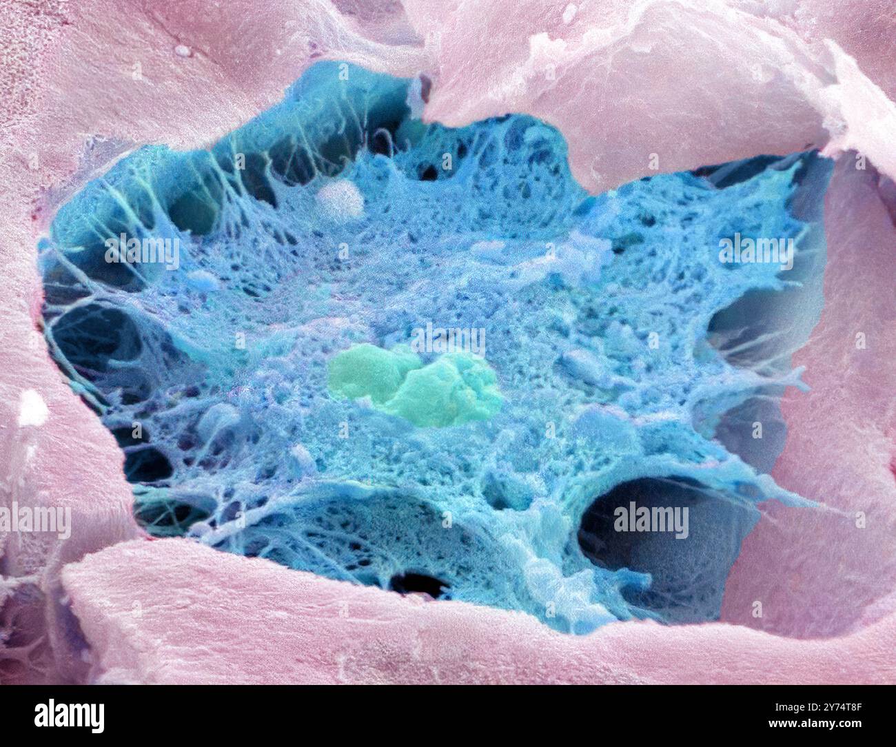 Osteozyten-Knochenzelle. Farbige Rasterelektronenmikrographie (REM) einer von Knochengewebe umgebenen Osteozytenknochenzelle. Diese gebrochene Zelle zeigt einen Kern in der Mitte. Osteozyten sind Osteoblasten (knochenbildende Zellen), die in Knochenhöhlen eingeschlossen sind (Lakunae, Depressionen im Knochen). Sie produzieren und sezernieren die organische Matrix des Knochens (Osteoid). Sobald sich Osteoid bildet, kristallisieren sich Calciumsalze darin und bilden einen harten, mineralisierten Knochen. Vergrößerung: x4000, wenn 10 Zentimeter breit gedruckt. Stockfoto