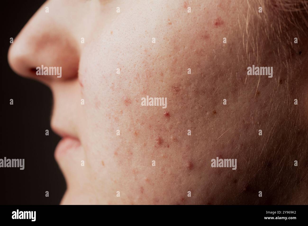 Schlechte Hautstruktur Closeup Akne Pickel. Behandlung der Haut. Problem-Hautpflege. Pickel, Akne, Poren, Narben. Natürliche Haut. Hautpflegekonzept. Akne Stockfoto