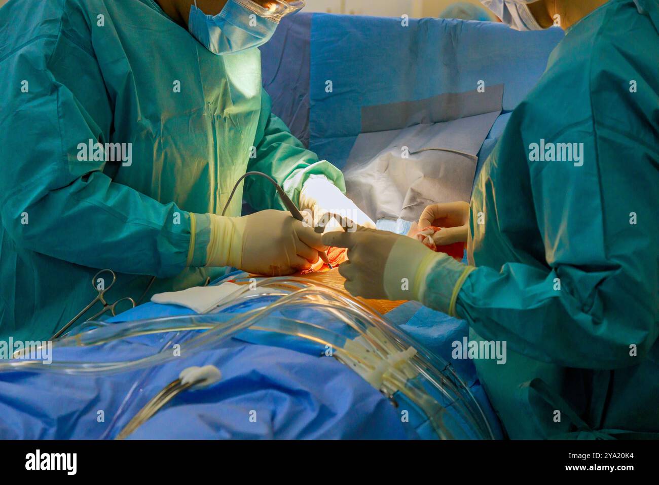 Chirurgisches Team führt Operationen am offenen Herzen im Operationssaal des Krankenhauses durch Stockfoto