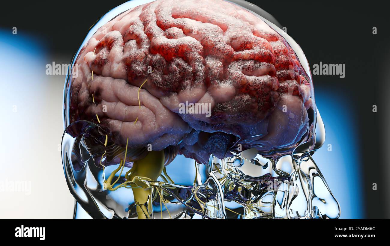 Anatomie des menschlichen Gehirns Nervensystem, Nervenkrebs, Talgkolben, Hirnkrebs Tumorwachstum und Ausbreitung maligner Zellen, Meningeom, neurologisches d Stockfoto