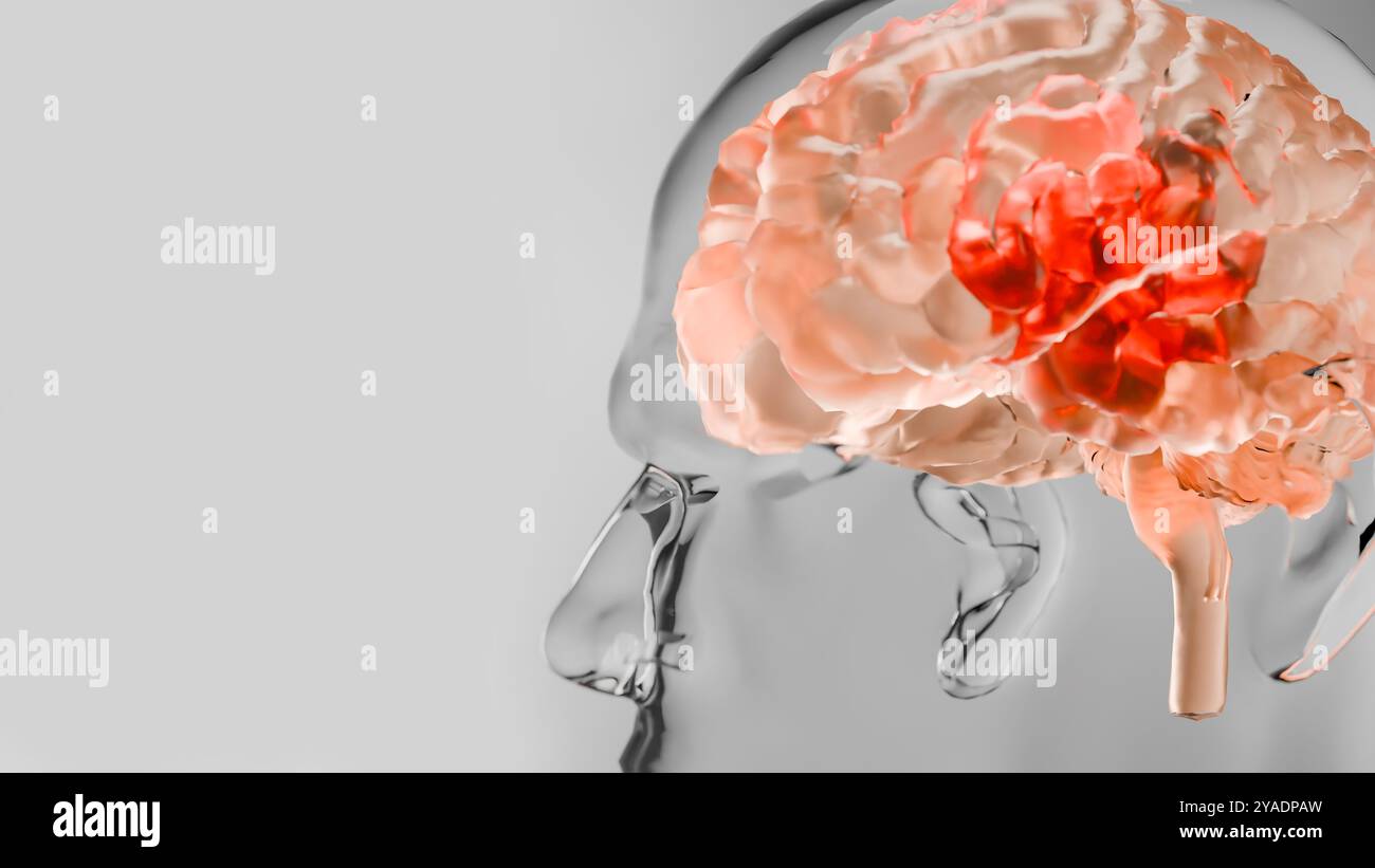 Anatomie des menschlichen Gehirns Nervensystem, Nervenkrebs, Talgkolben, Hirnkrebs Tumorwachstum und Ausbreitung maligner Zellen, Meningeom, neurologisches d Stockfoto