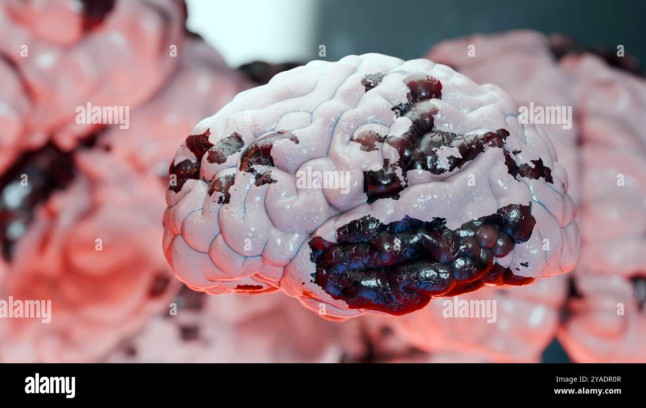 Anatomie des menschlichen Gehirns Nervensystem, Nervenkrebs, Talgkolben, Hirnkrebs Tumorwachstum und Ausbreitung maligner Zellen, Meningeom, neurologisches d Stockfoto