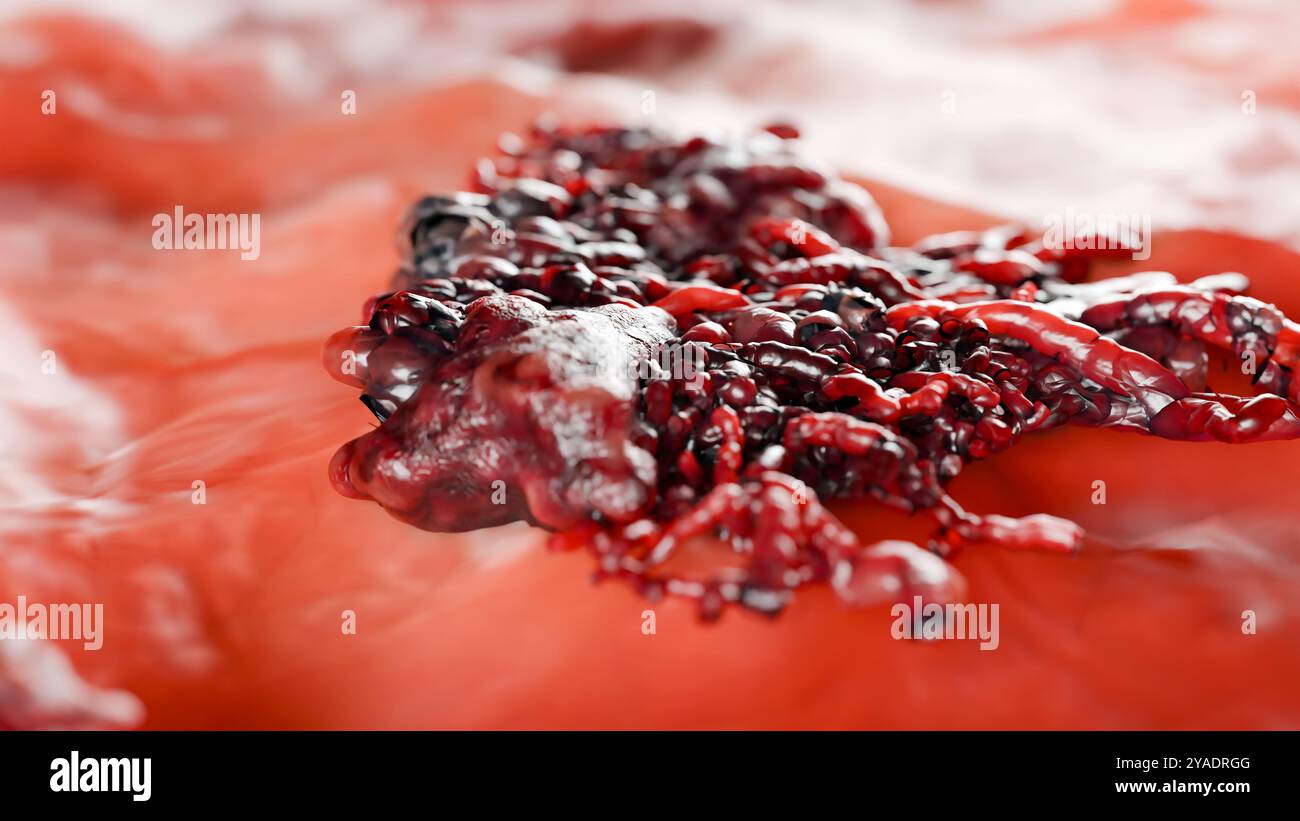 Unkontrolliertes Wachstum von Krebszellen über Gewebe, Tumorinfektionszellen und Ausbreitung, invasive Entzündungsmetastasen krebserregend. Durch Duplikate reproduzieren Stockfoto