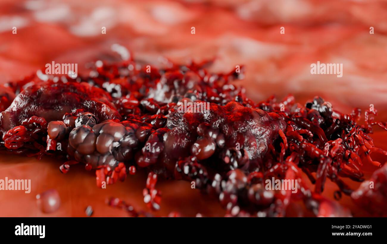 Unkontrolliertes Wachstum von Krebszellen über Gewebe, Tumorinfektionszellen und Ausbreitung, invasive Entzündungsmetastasen krebserregend. Durch Duplikate reproduzieren Stockfoto